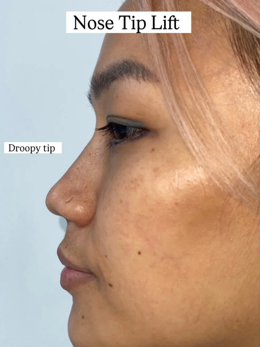 A droopy nose tip can be gently lifted and refined with carefully placed injectable treatments. 

Using advanced techniques, we can support the tip, improve balance, and enhance your profile with dermal fillers and other treatments as well. 

Small c