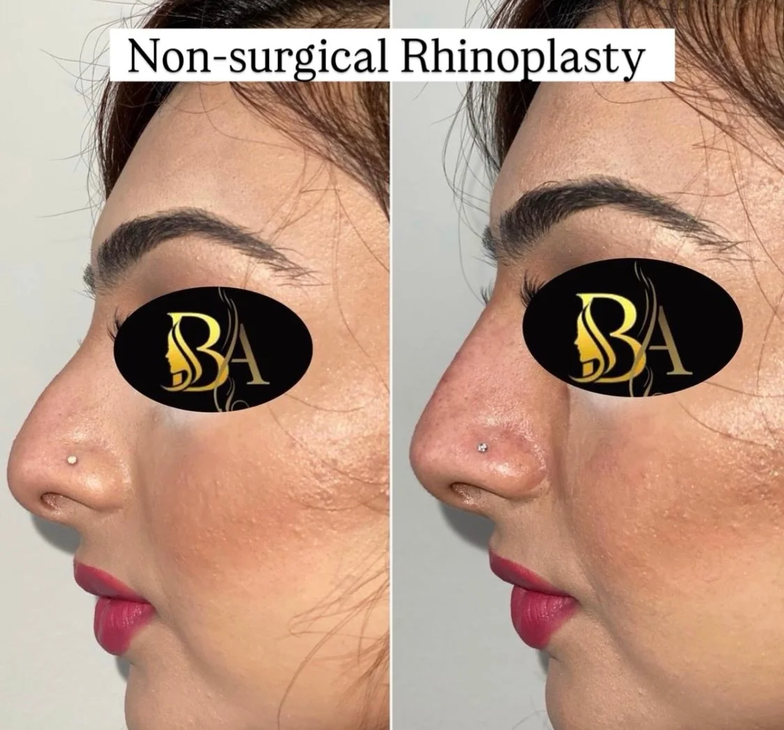 Nose fillers are a great alternative to surgery. Here are some of the benefits: 

Nose fillers are a non-surgical alternative to rhinoplasty surgery. 
 
The procedure is quick and can be performed with a tiny needle. 
 
There is no need for a long he