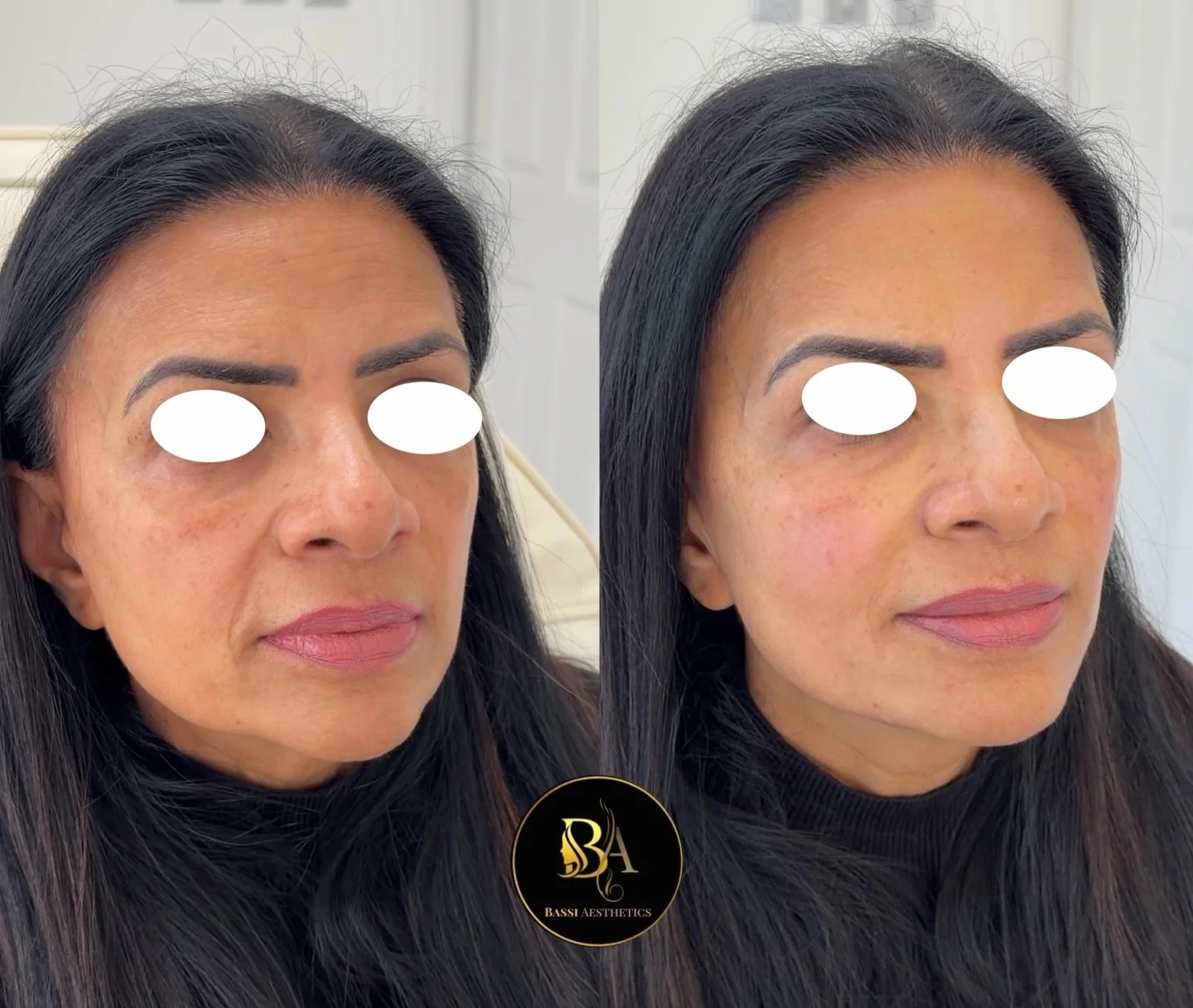 This client wanted to soften the lower face and restore a more lifted, refreshed look.

We started by adding filler to the mid cheek area, which helps restore lost volume and provides support to the smile lines. By lifting this area first, it can nat