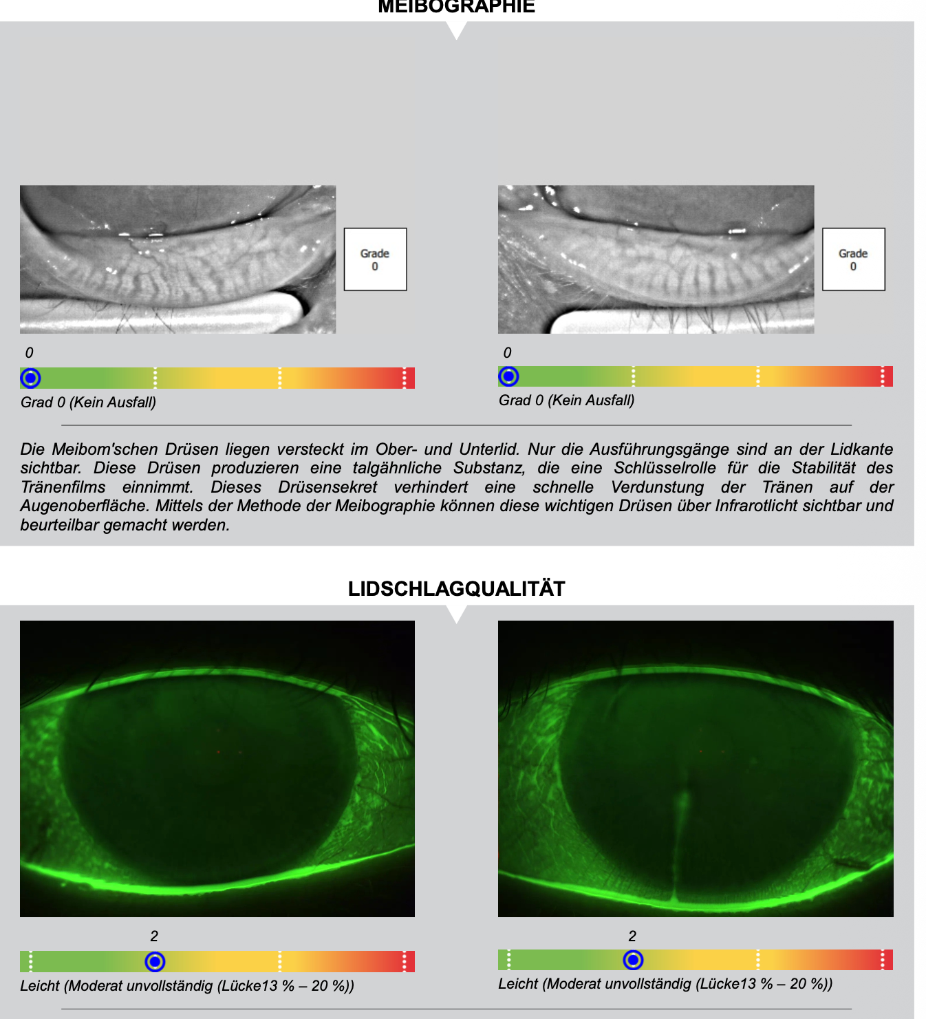 Ausschnitt aus dem Dry-Eye-Report: Meibographie-Aufnahmen der Lidränder zur Beurteilung der Meibom-Drüsen sowie Auswertung der Lidschlagqualität mit grafischer Darstellung der Ergebnisse.