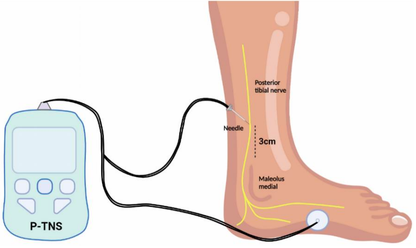 Posterior Tibial Nerve Stimulation for Overactive Bladder Treatment