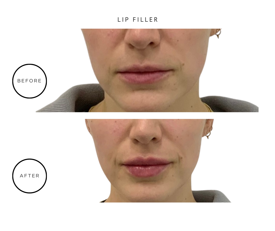 BEFORE & AFTER - Lip Filler NYC.png