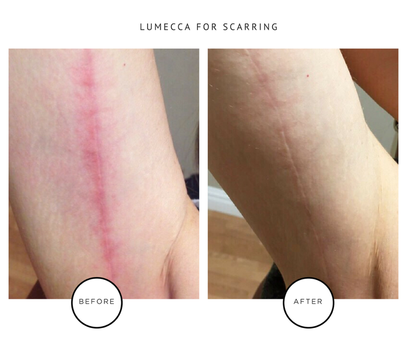 LUMECCA+FOR+SCARRING-2.png
