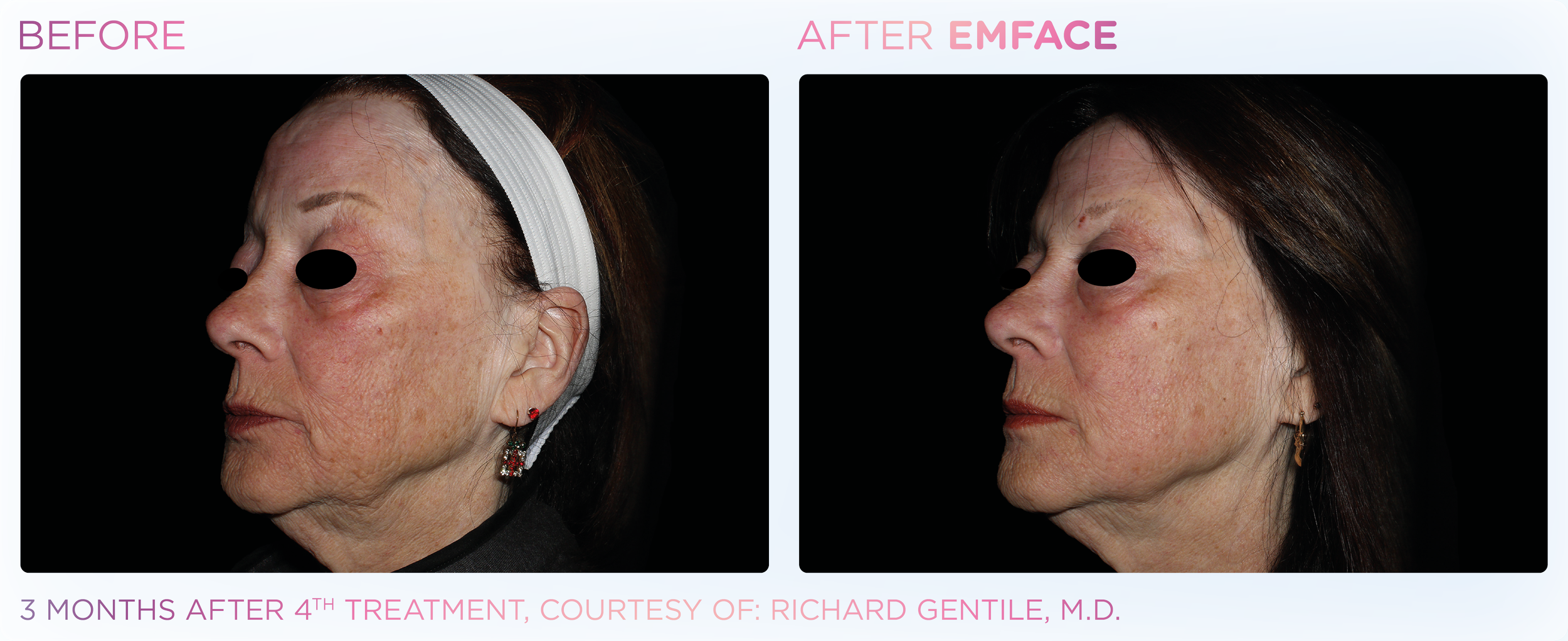 Emface_PIC_Ba-card-female-face-052_ENUS100.png