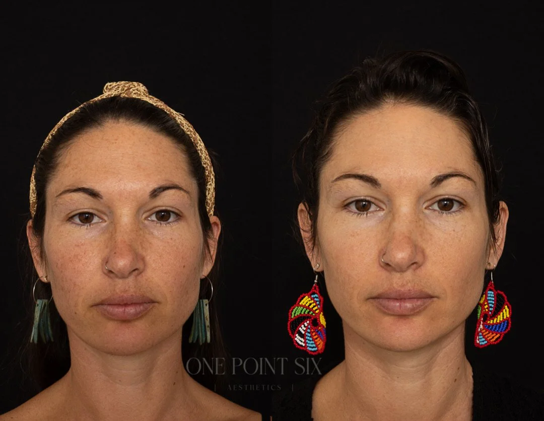 Non bordered IPL B&A.jpg