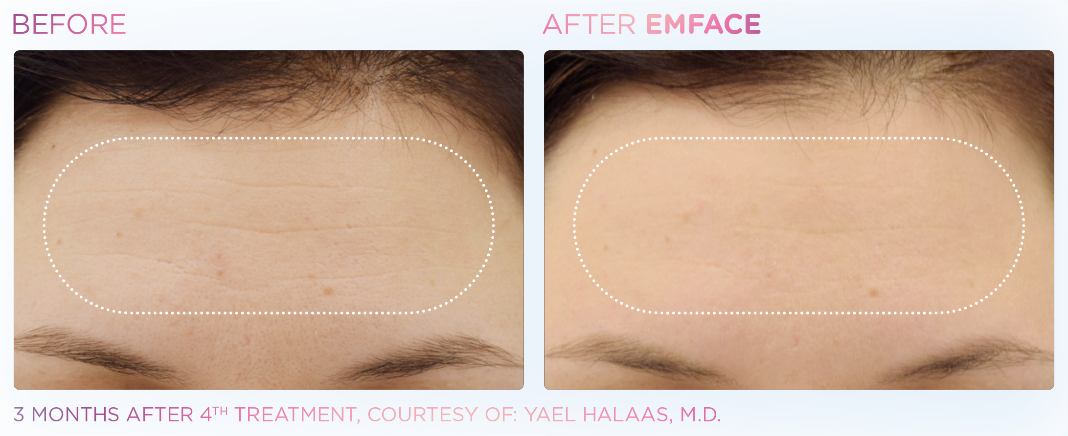 Emface_PIC_Ba-card-female-forehead-021_ENUS100.png