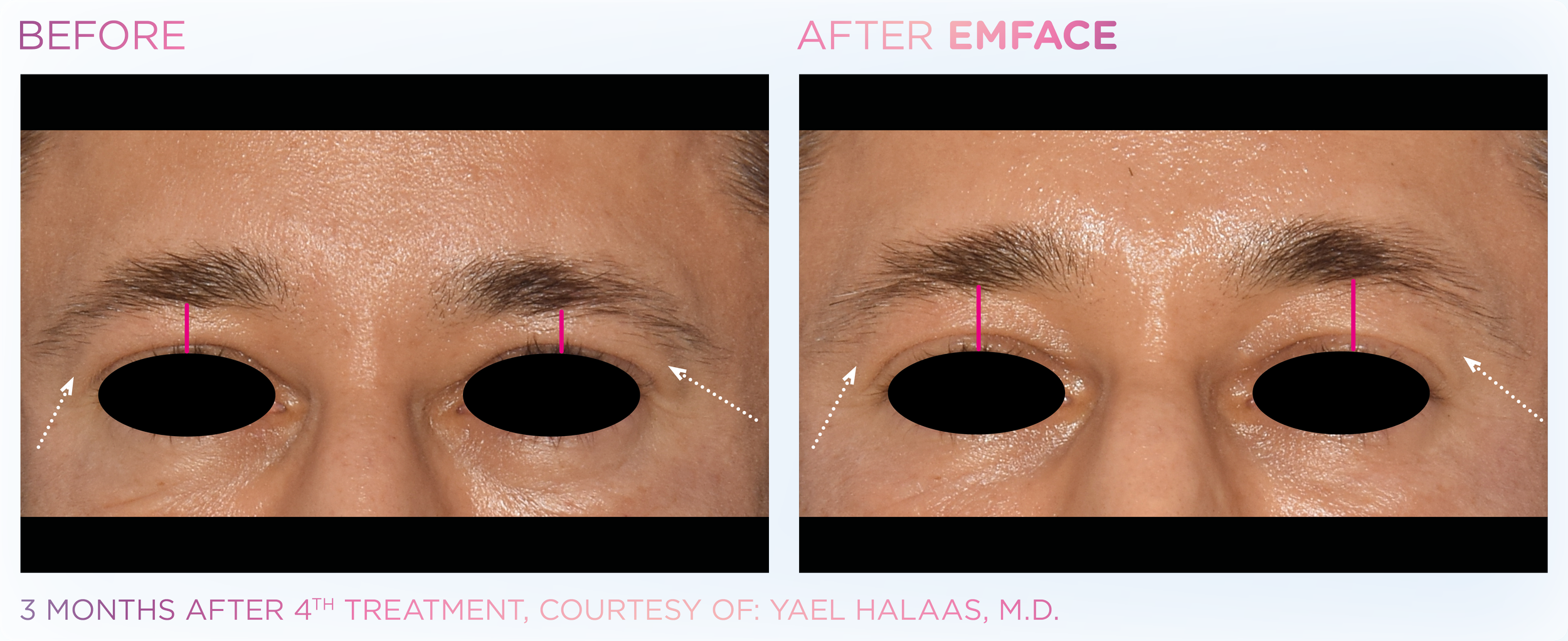 Emface_PIC_Ba-card-male-eyebrows-033_ENUS100.png