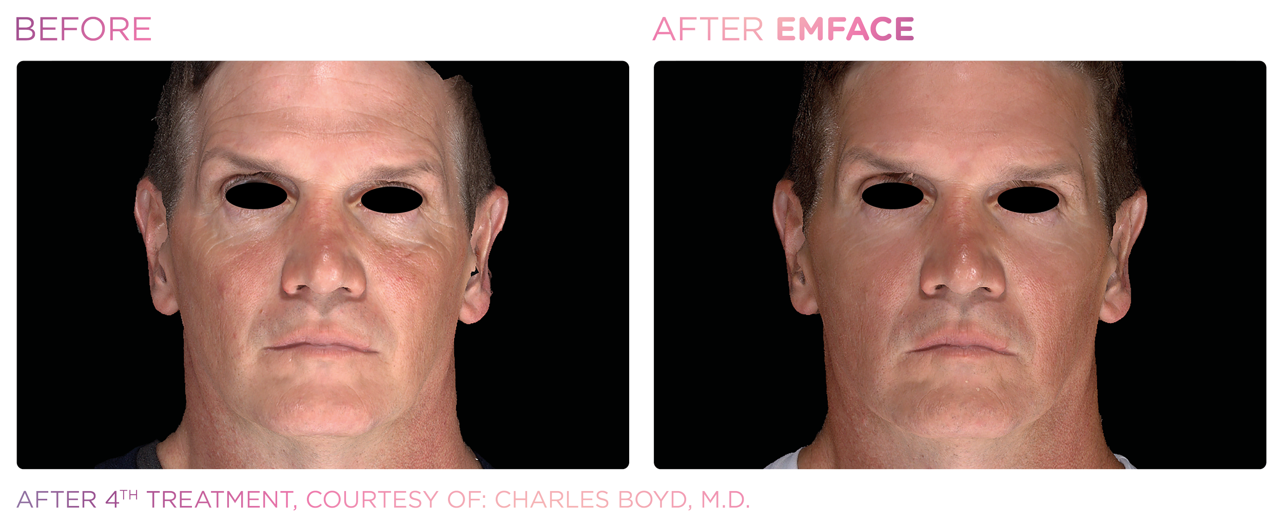 Emface_PIC_Ba-card-male-face-053_ENUS100.png