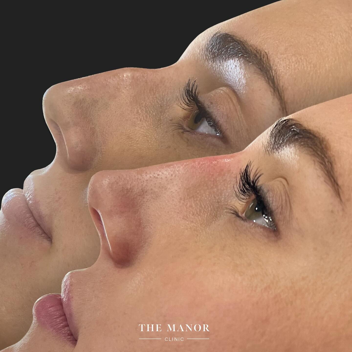 ⚖️ NOSE BALANCE ⚖️ 

Non-surgical rhinoplasty uses dermal filler to reduce the appearance of nasal hooks, bumps whilst disguising prominent bridges. This treatment also has the ability to add definition and lift downward turning nose tips. 

At The M