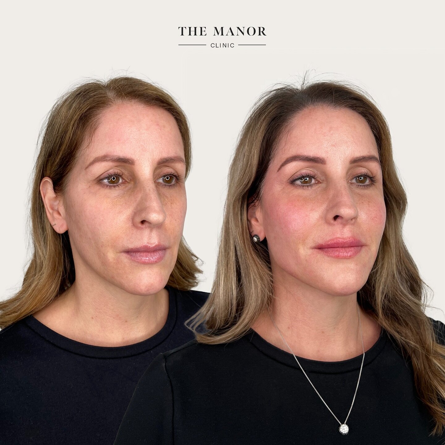 📝 Breaking the Rules&nbsp;📝&nbsp;

This vivacious woman started her journey at The Manor Clinic in April 2023 with the overarching objective of looking natural with noticeable results.&nbsp;

Treatment List:&nbsp;
▪️Temples
▪️Cheeks
▪️Jawline
▪️Chi