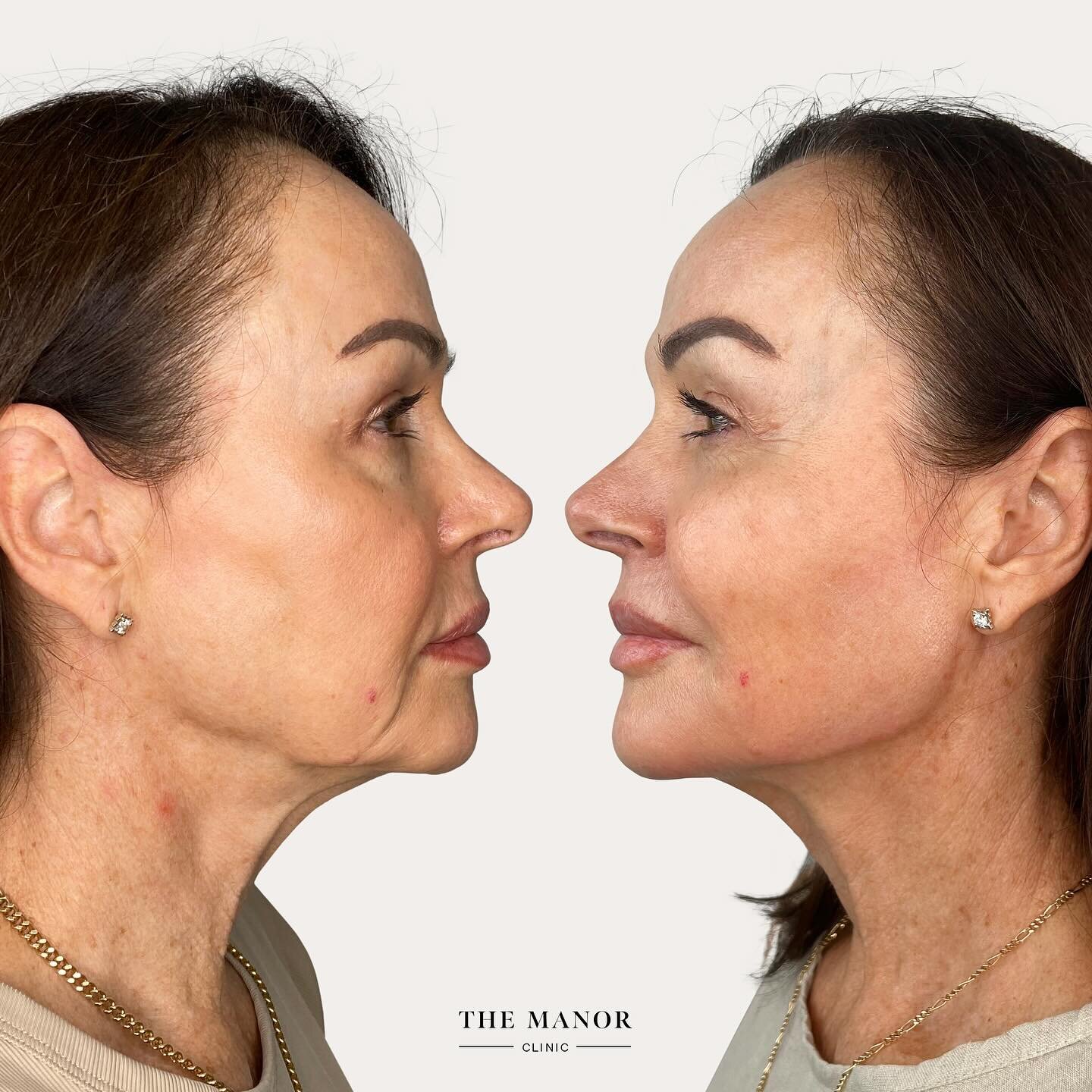 🔓 Unlocking the beauty of ageing gracefully 

Meet Sharon, a 61-year-old woman who sought a refreshed and rejuvenated version of herself. 

We live in a society that often emphasises growing old gracefully. Sharon&rsquo;s choice of non-surgical cosm