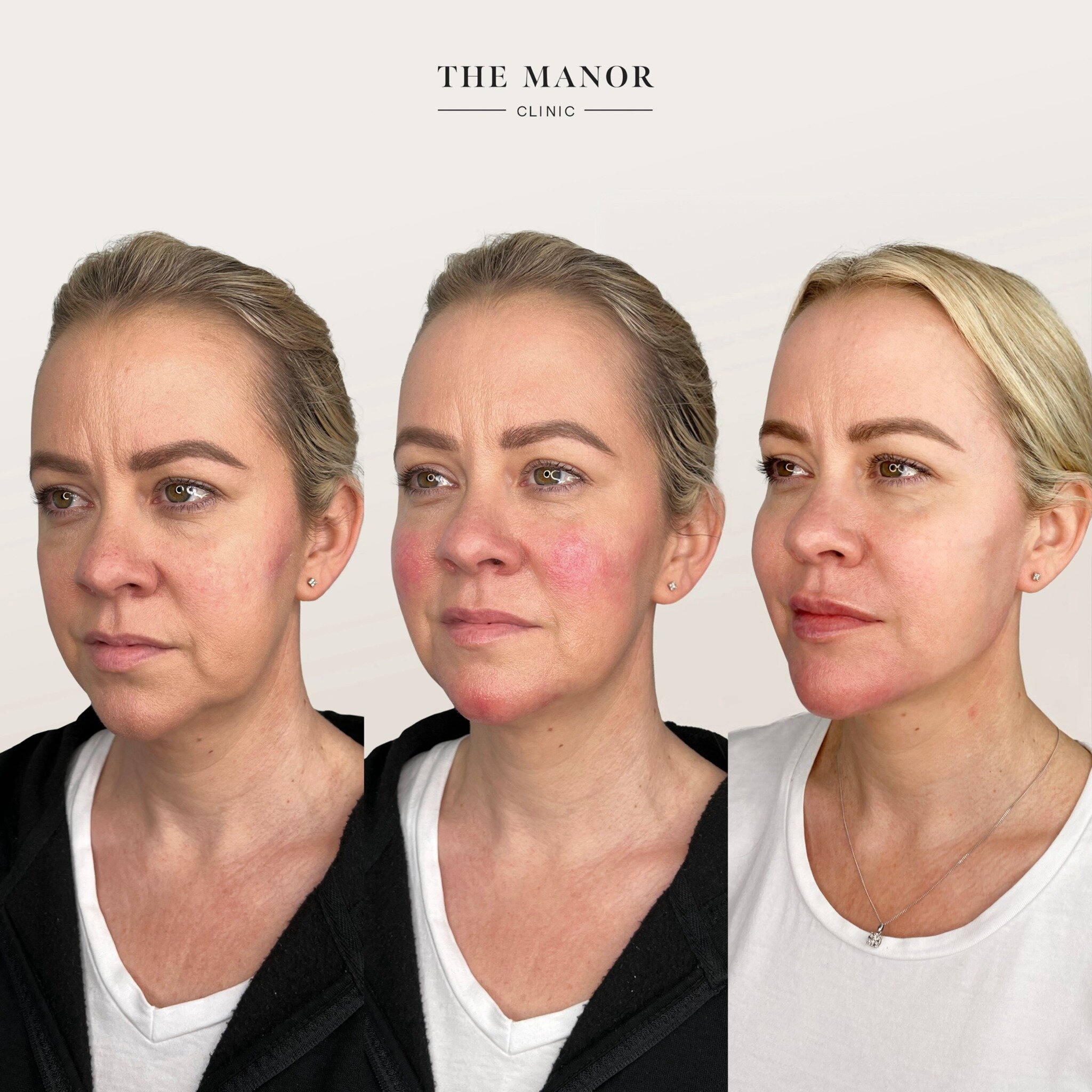 Our favourite case of the week 📆

Amelia requested a full face refresh to help her feel and look her best. The groundwork was completed in the initial sessions, followed by fine-tuning in subsequent appointments. Amelia and our team were pleasantly 
