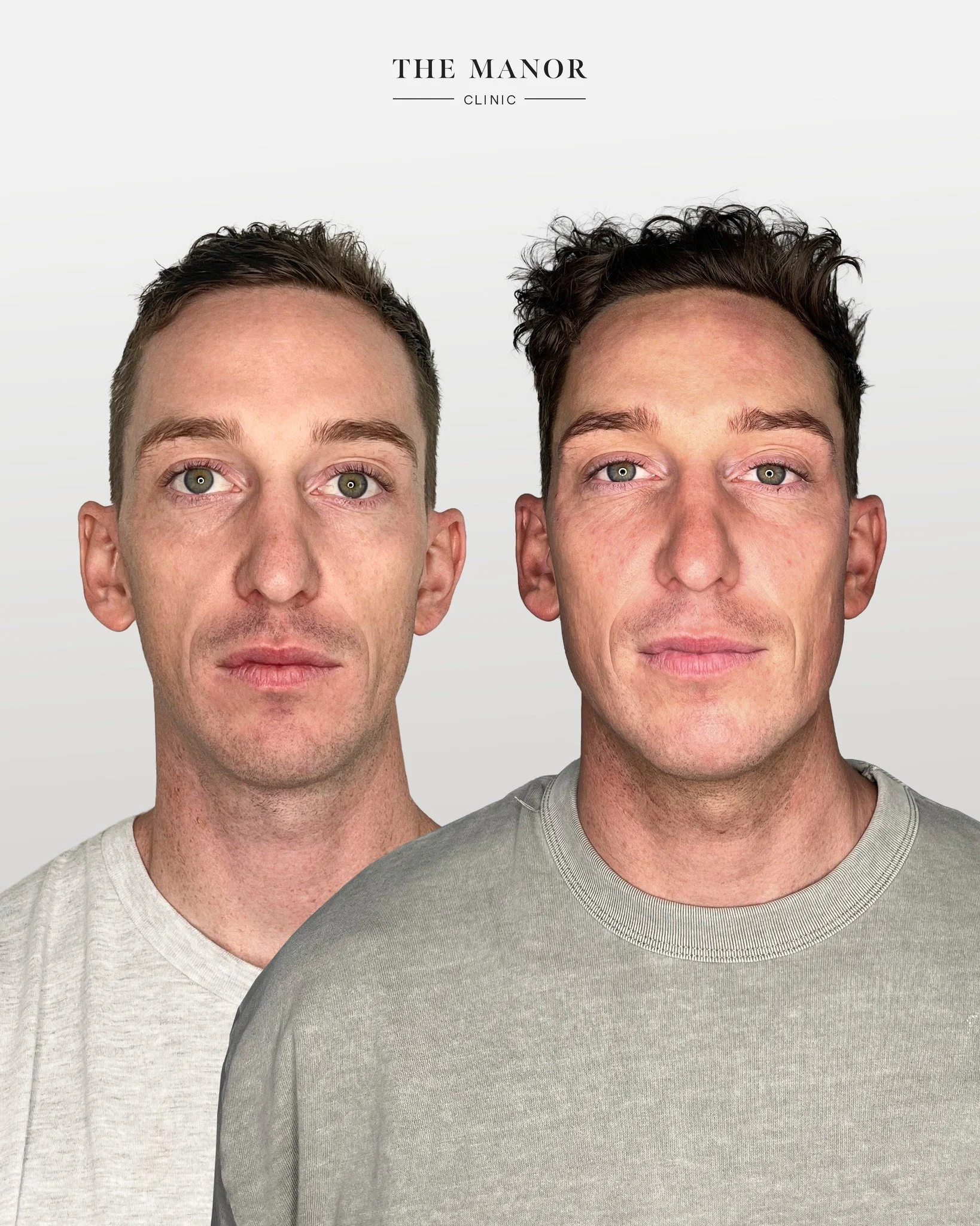 Disclaimer: The Manor Clinic provides multimodal treatments that may improve skin health, restore volume loss, and address asymmetry. Prior to the commencement of any treatment at The Manor Clinic, a consultation is mandatory to ascertain treatment s
