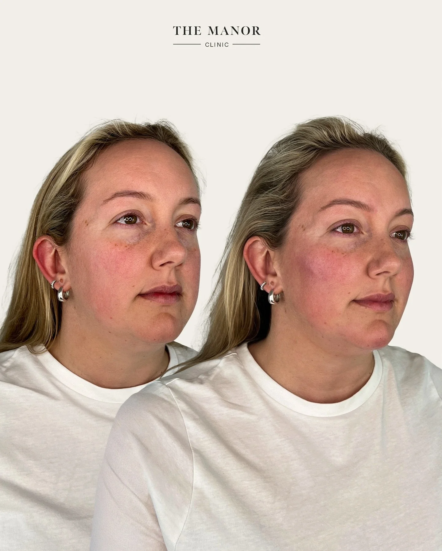 Disclaimer: The Manor Clinic provides multimodal treatments that may improve skin health, restore volume loss, and address asymmetry. Prior to the commencement of any treatment at The Manor Clinic, a consultation is mandatory to ascertain treatment s