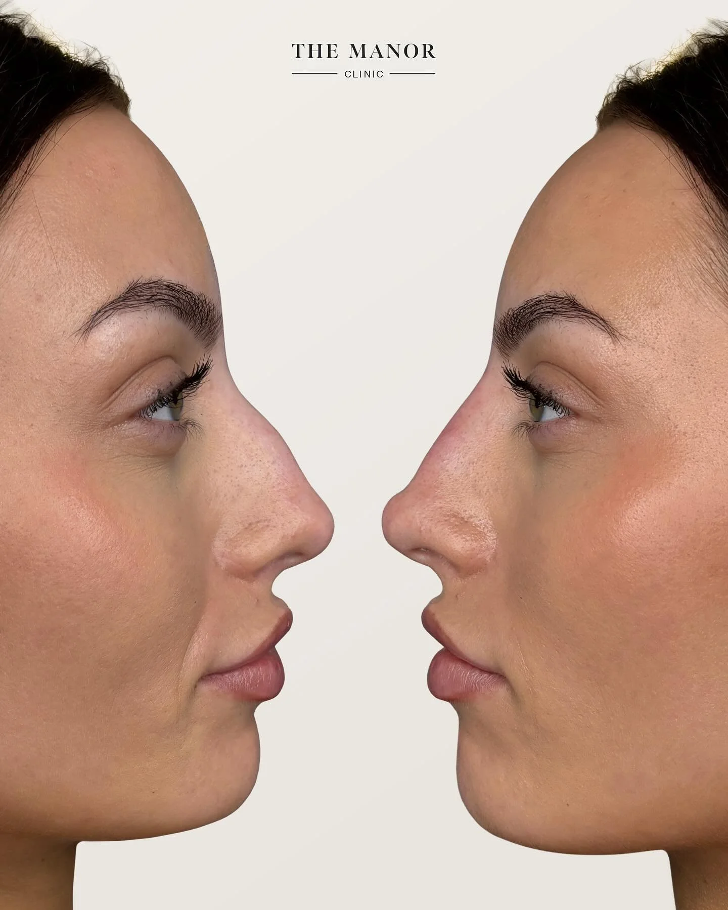 Disclaimer: The Manor Clinic provides multimodal treatments that may improve skin health, restore volume loss, and address asymmetry. Prior to the commencement of any treatment at The Manor Clinic, a consultation is mandatory to ascertain treatment s
