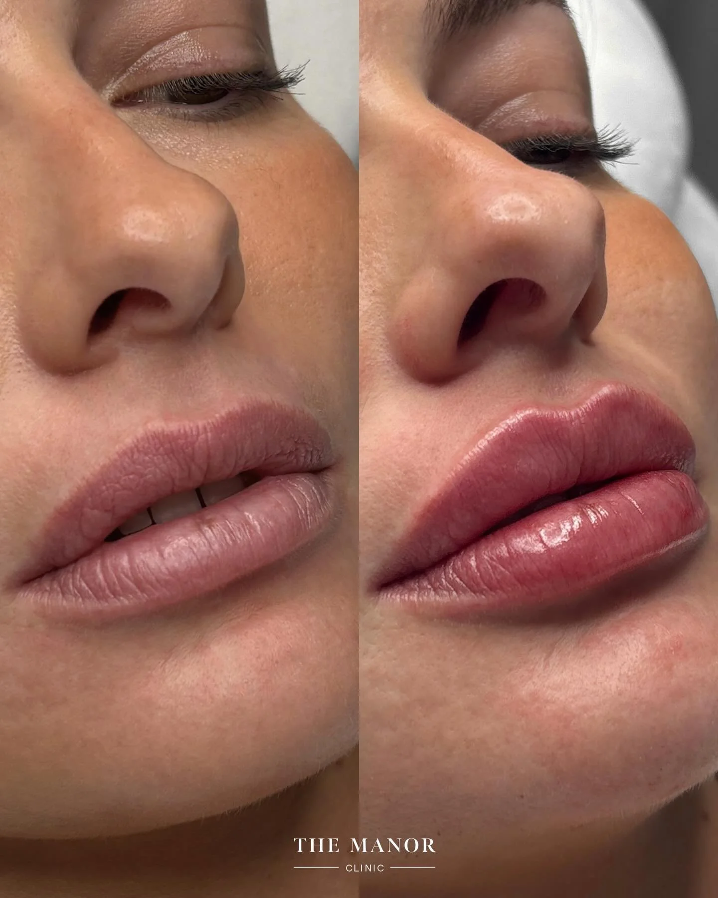 Disclaimer: Information on Risks &amp; Recovery via link in bio. The Manor Clinic provides multimodal treatments that may improve skin health, restore volume loss, and address asymmetry. Prior to the commencement of any treatment at The Manor Clinic,