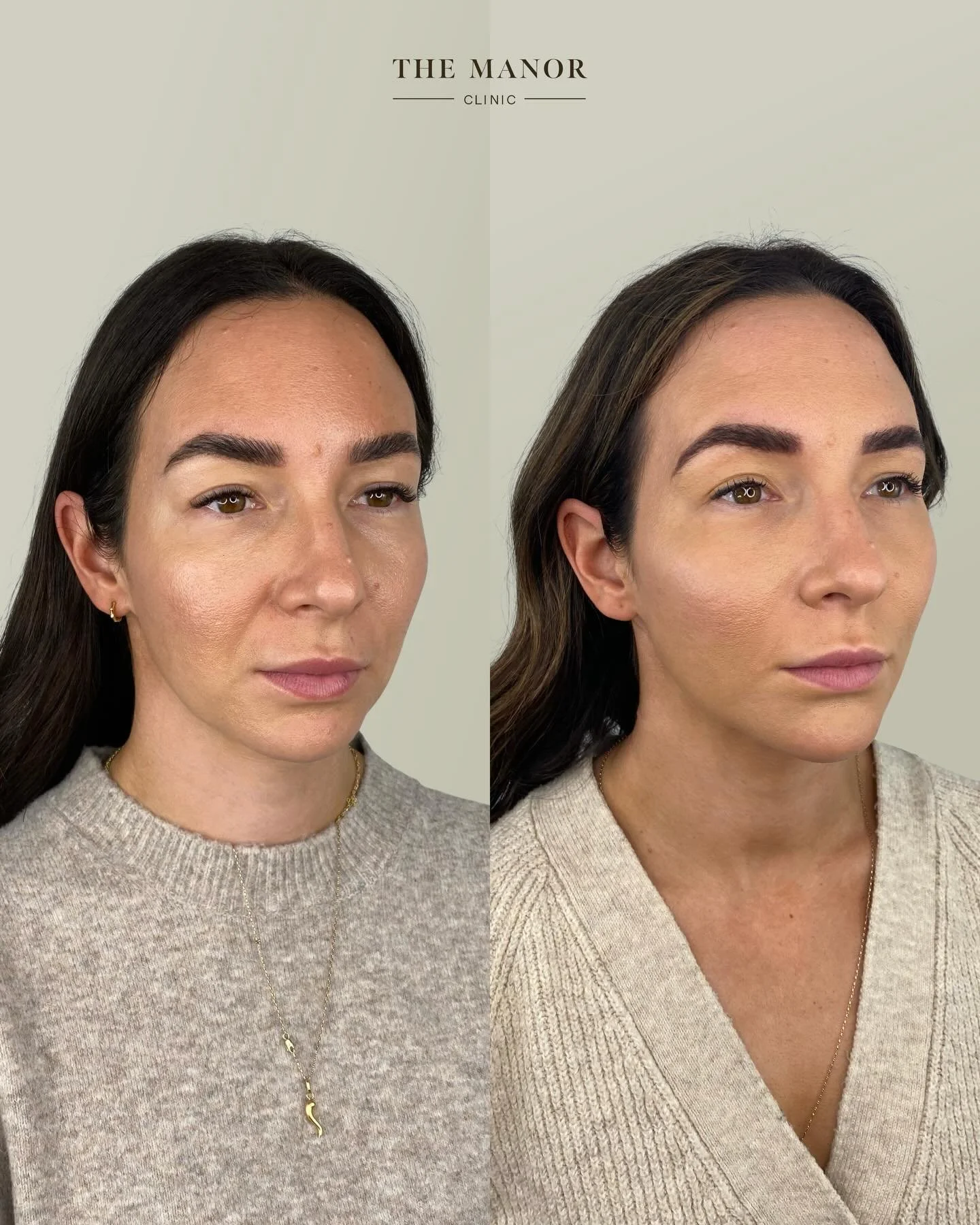 Disclaimer: Information on Risks &amp; Recovery via link in bio. The Manor Clinic provides multimodal treatments that may improve skin health, restore volume loss, and address asymmetry. Prior to the commencement of any treatment at The Manor Clinic,