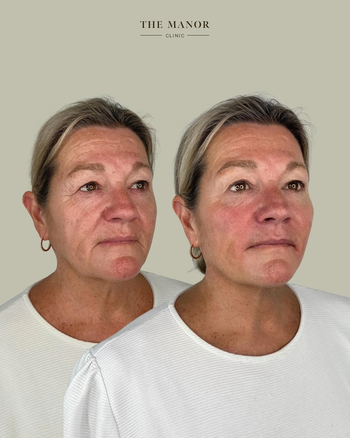 Disclaimer: Information on Risks &amp; Recovery via link in bio. The Manor Clinic provides multimodal treatments that may improve skin health, restore volume loss, and address asymmetry. Prior to the commencement of any treatment at The Manor Clinic,