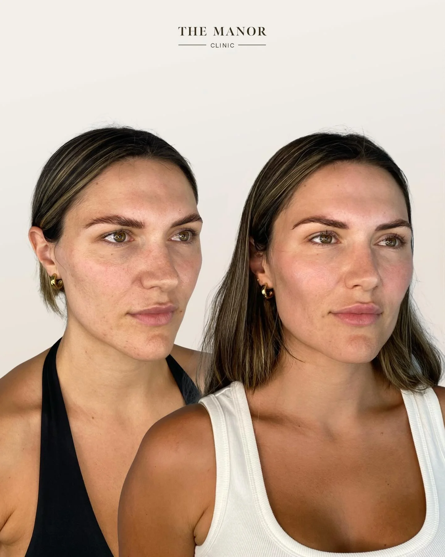 Disclaimer: Information on Risks &amp; Recovery via link in bio. The Manor Clinic provides multimodal treatments that may improve skin health, restore volume loss, and address asymmetry. Prior to the commencement of any treatment at The Manor Clinic,