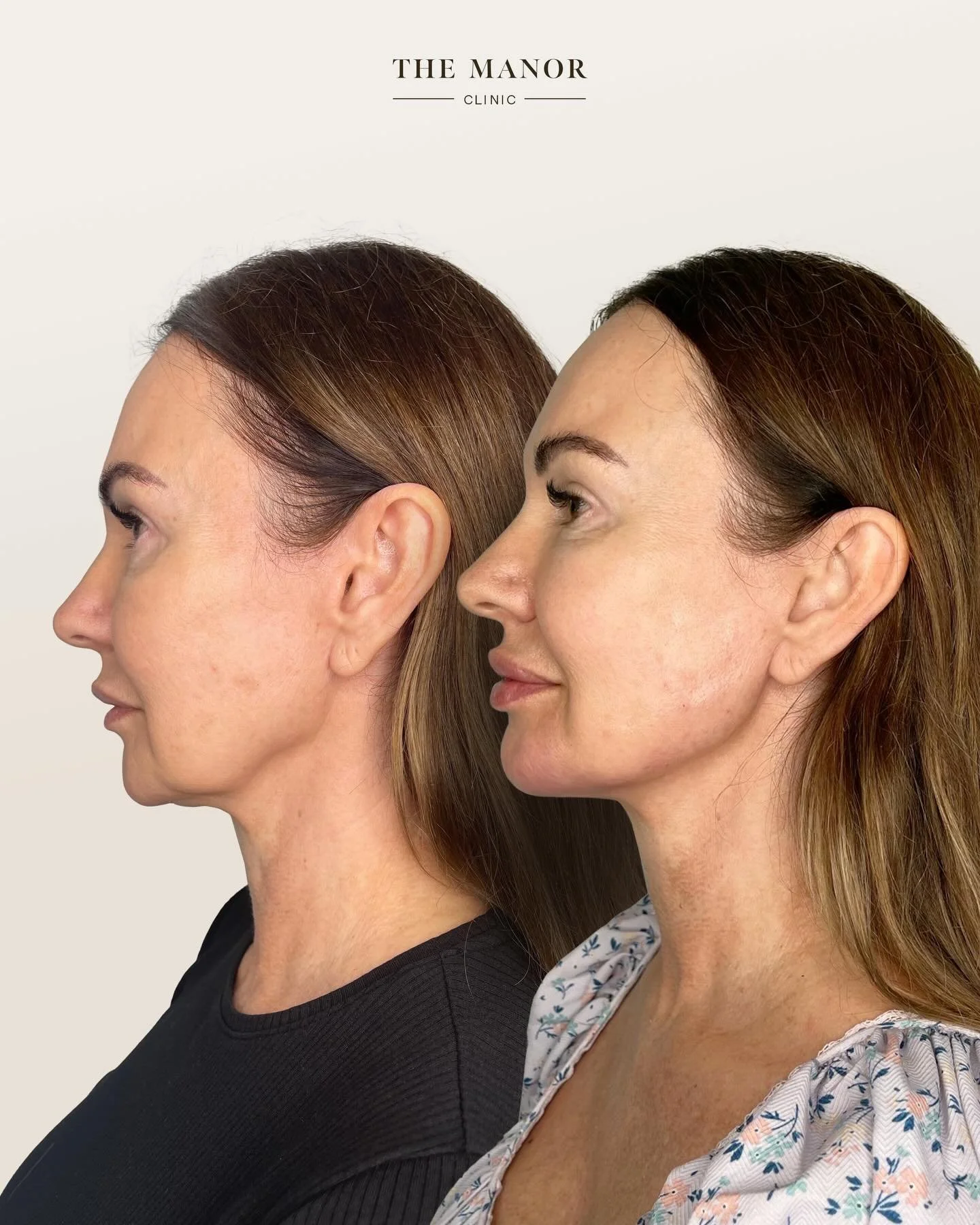Disclaimer: Information on Risks &amp; Recovery via link in bio. The Manor Clinic provides multimodal treatments that may improve skin health, restore volume loss, and address asymmetry. Prior to the commencement of any treatment at The Manor Clinic,