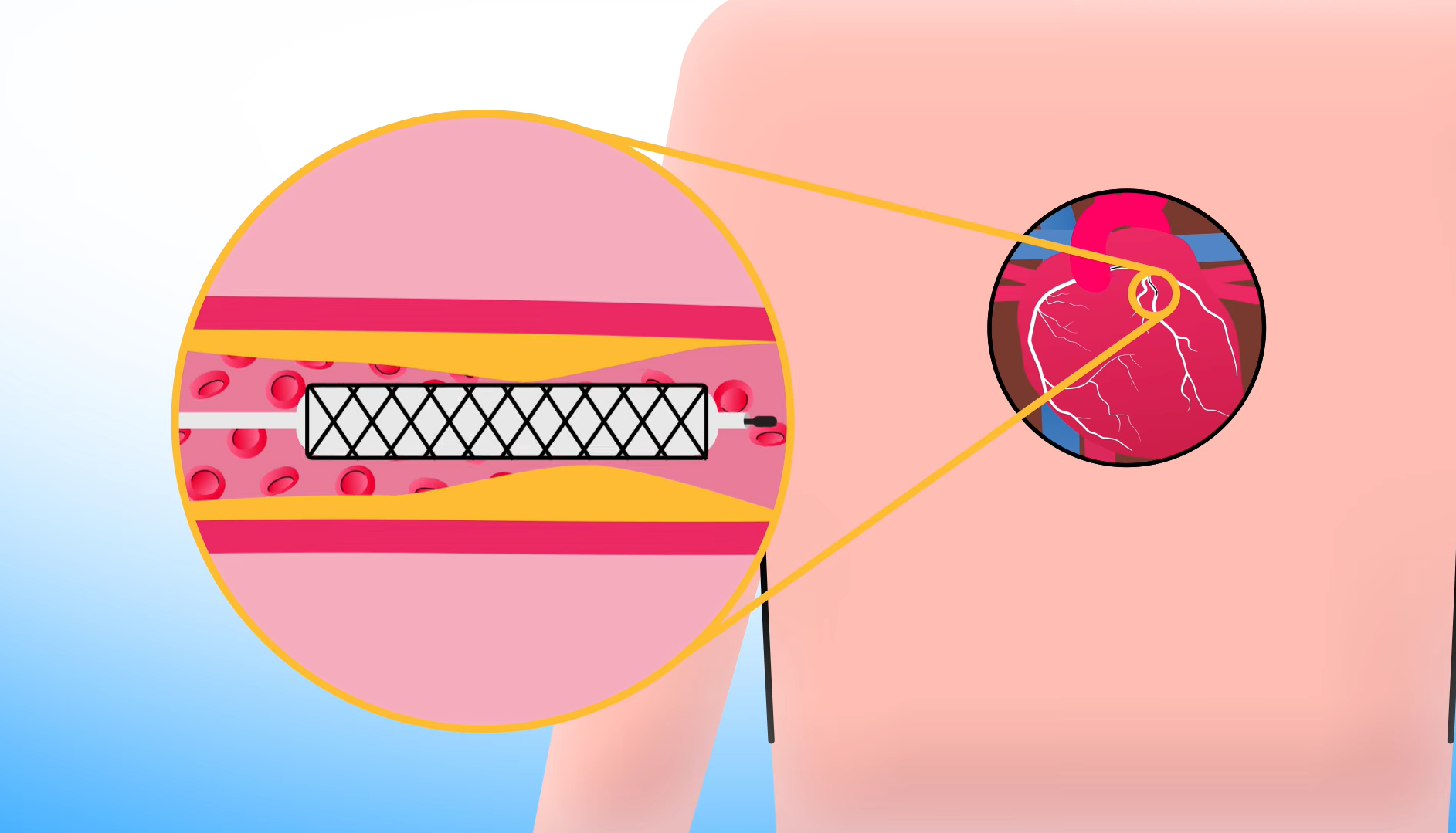 Magnified view shows stent opening a narrowed artery.