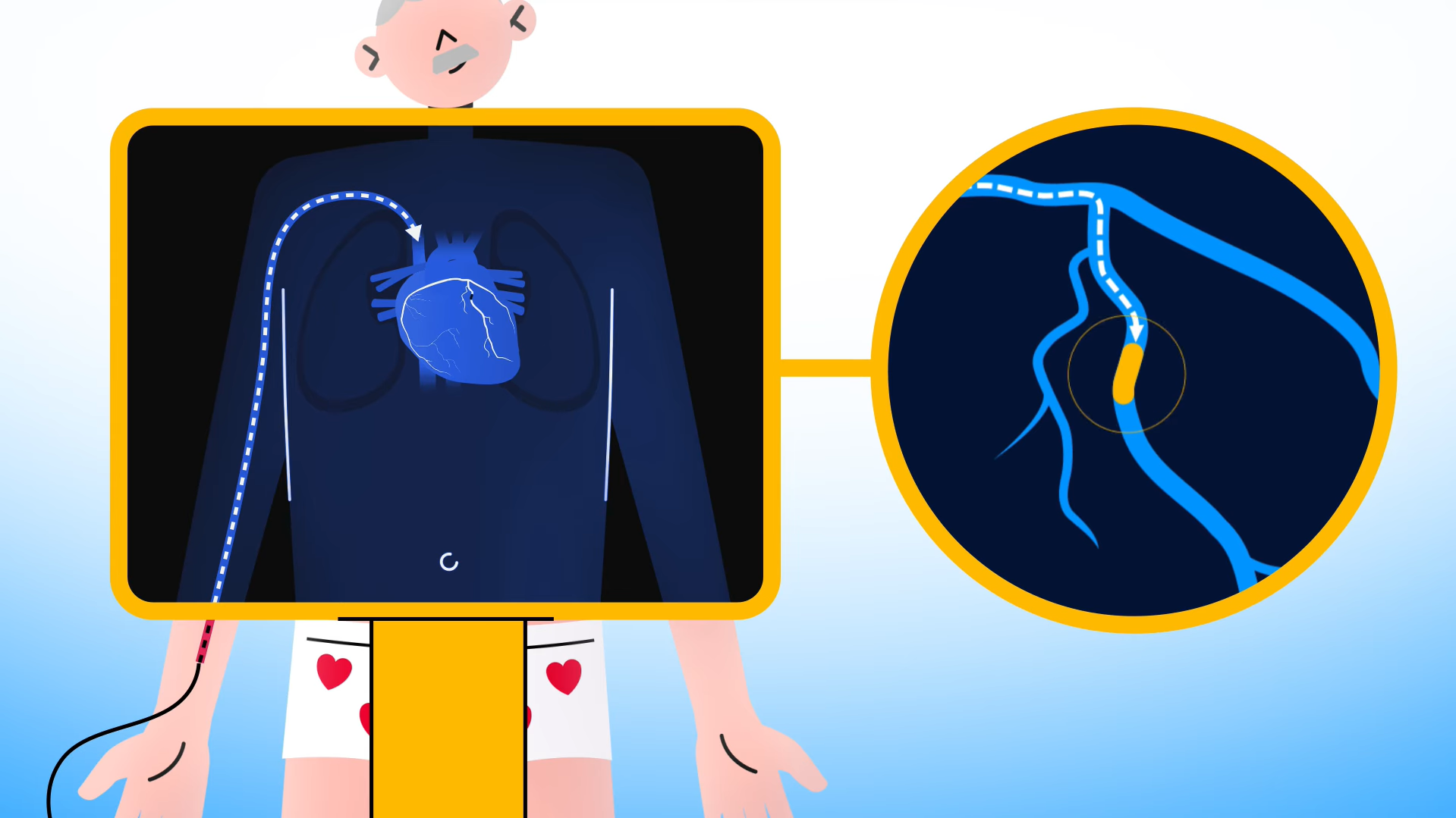 Medical screen displays catheter reaching heart through blood vessel.
