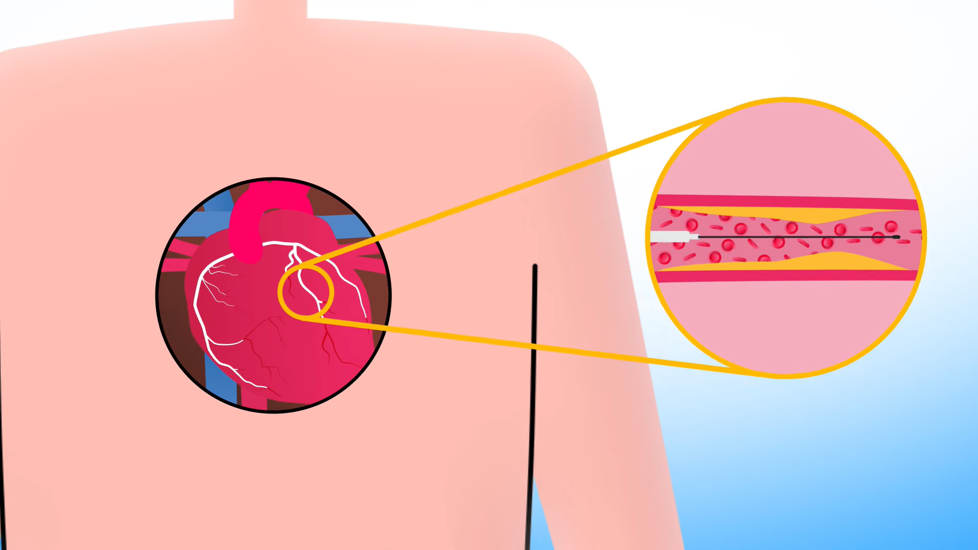 Close-up diagram shows blocked artery near the heart.