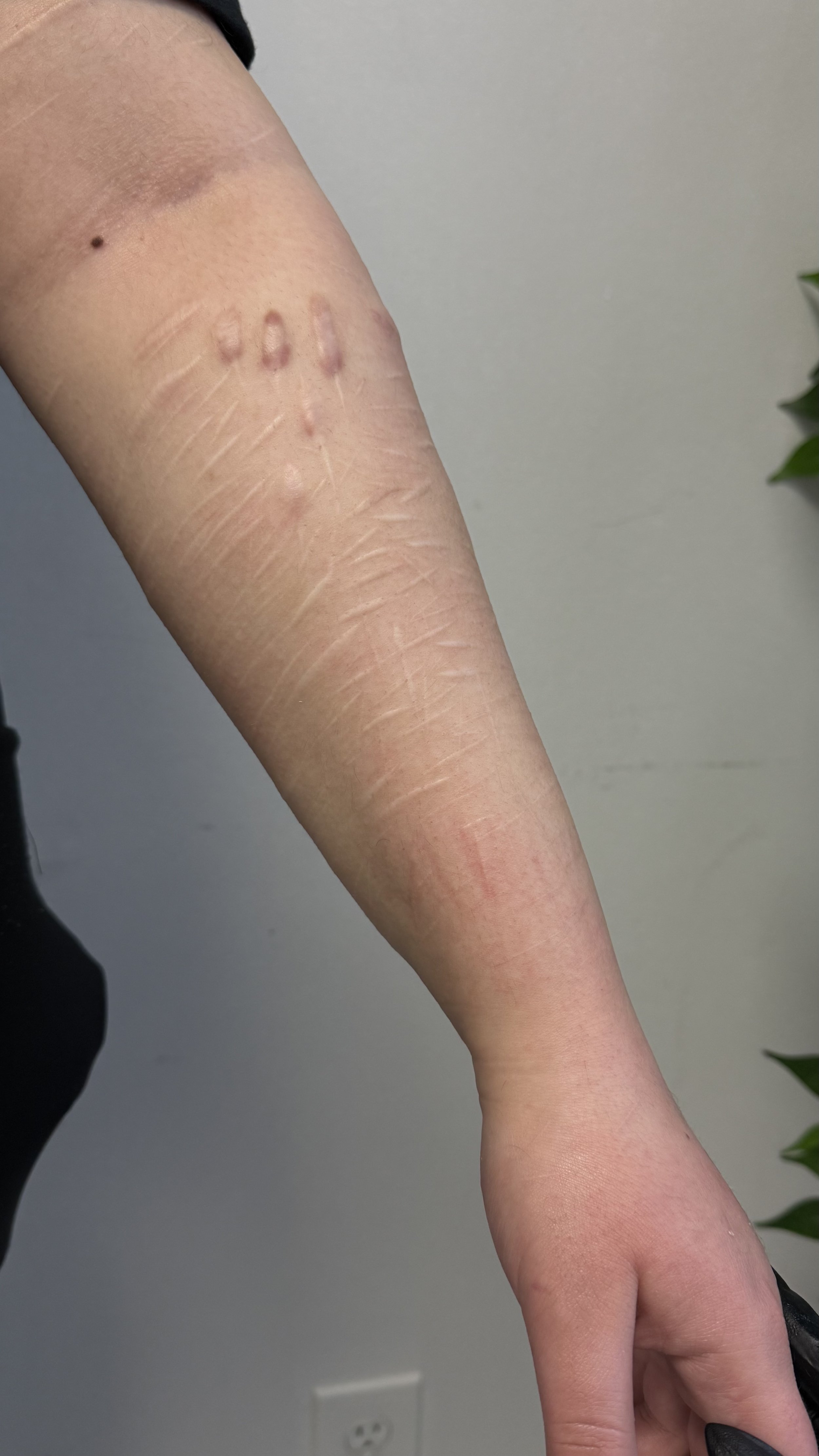 Healed scars and stretch marks on the forearm before tattooing