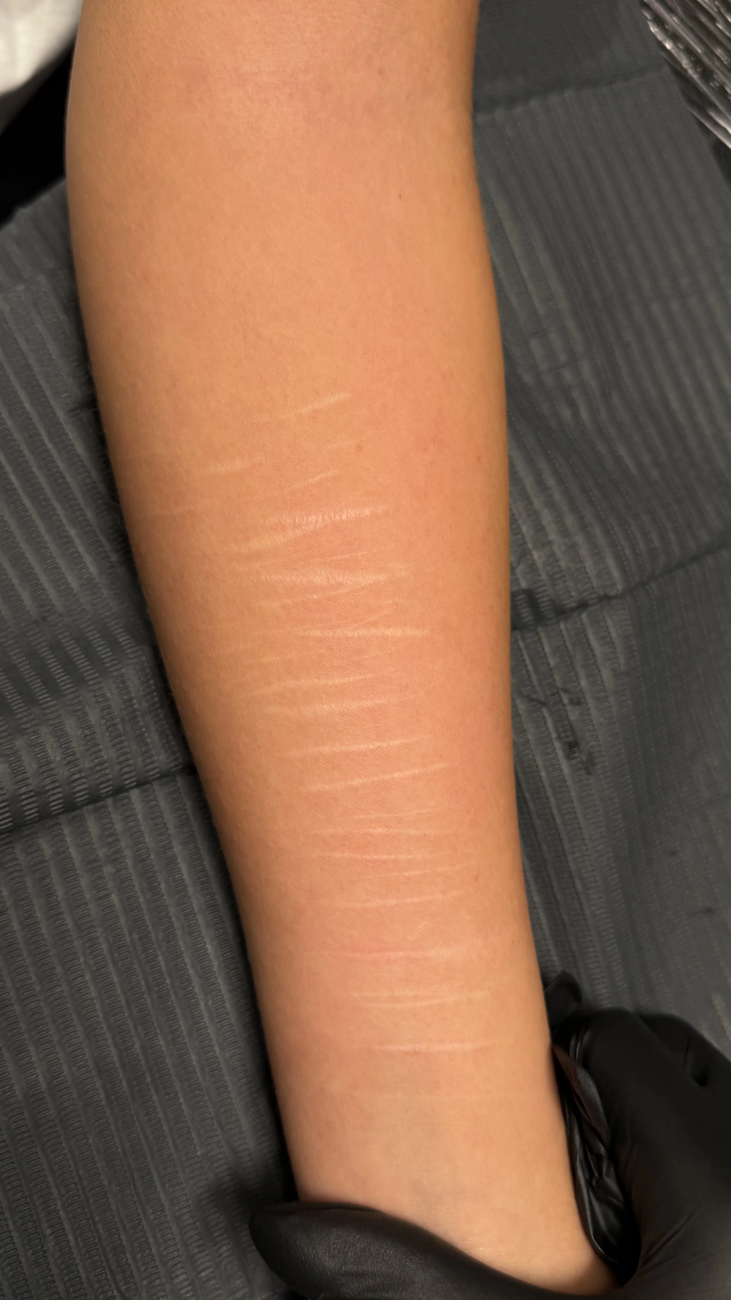 Visible healed scars on the forearm before a custom scar cover-up tattoo.
