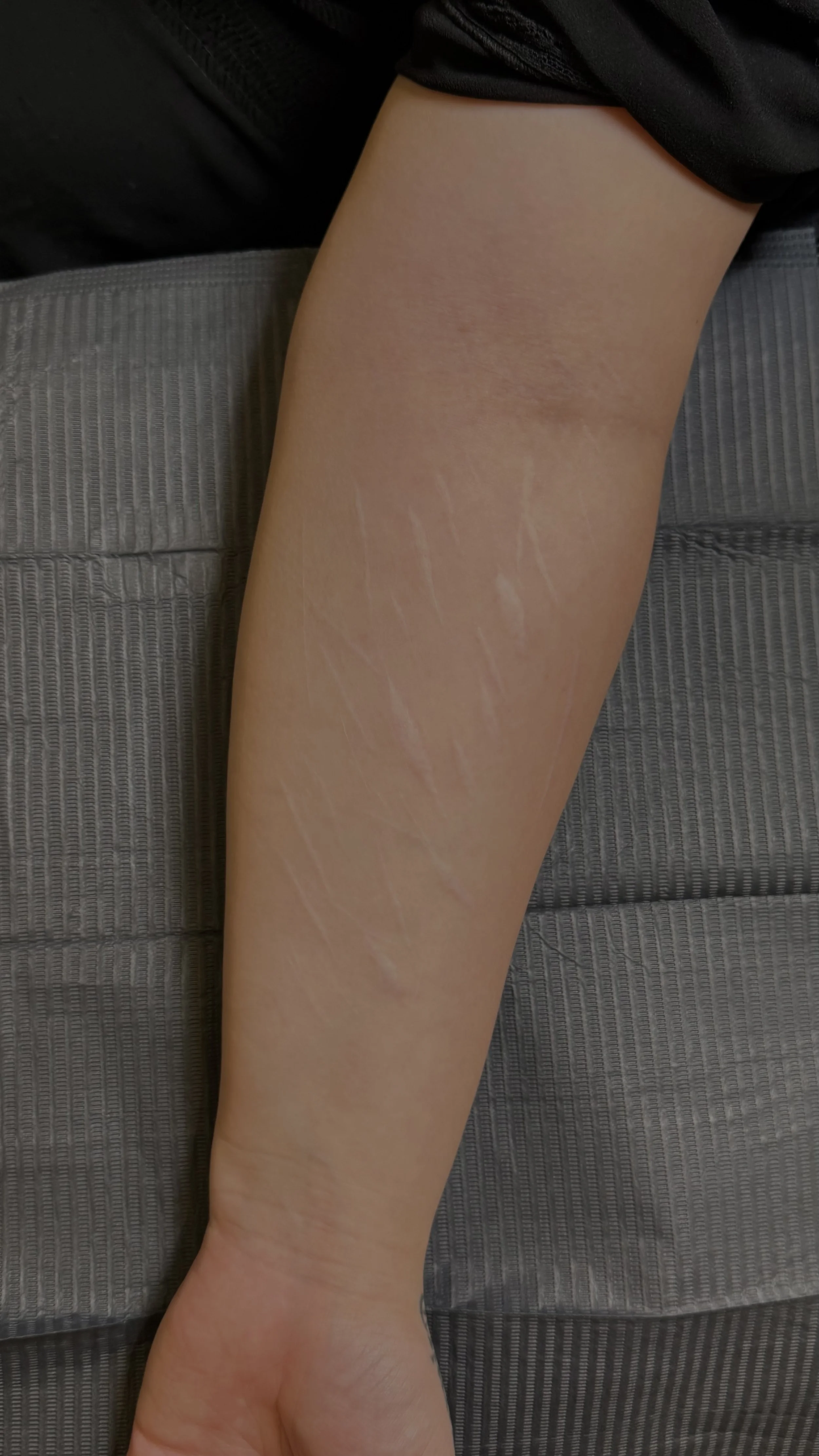 Visible healed scars on the forearm before a custom tattoo cover-up.