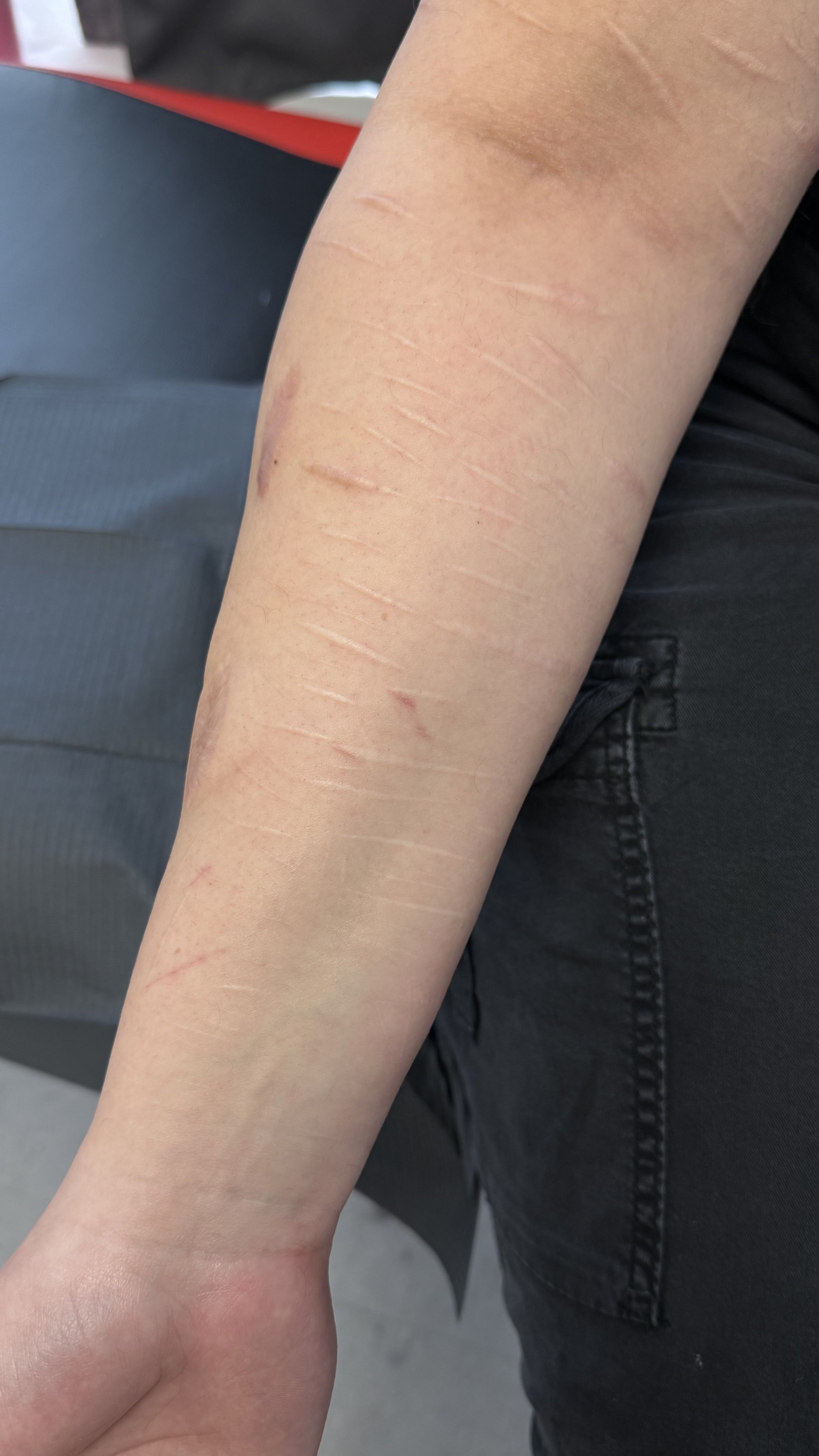 Healed scars on the forearm before a custom scar cover-up tattoo.