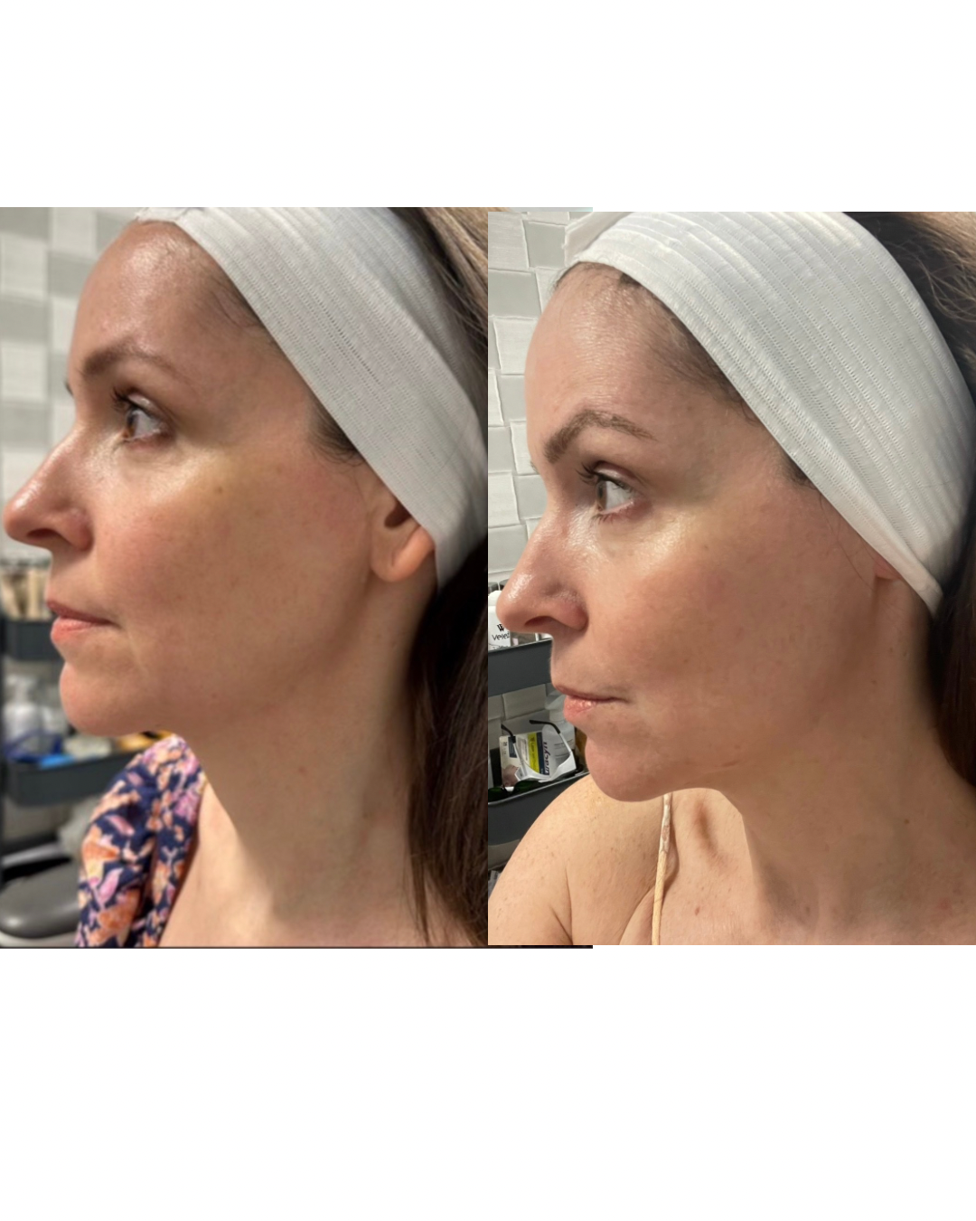 MOXI Laser Resurfacing