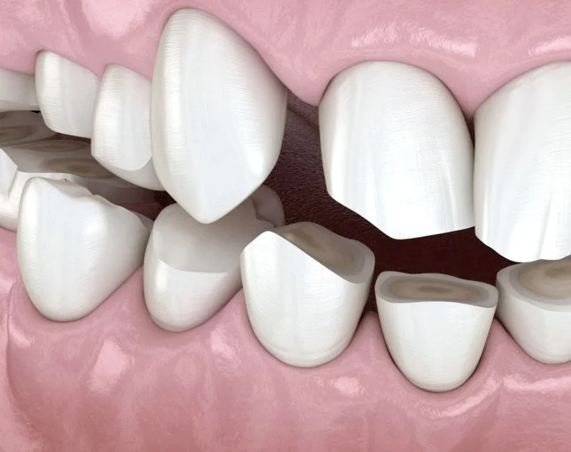 Bruxismo dientes.jpg