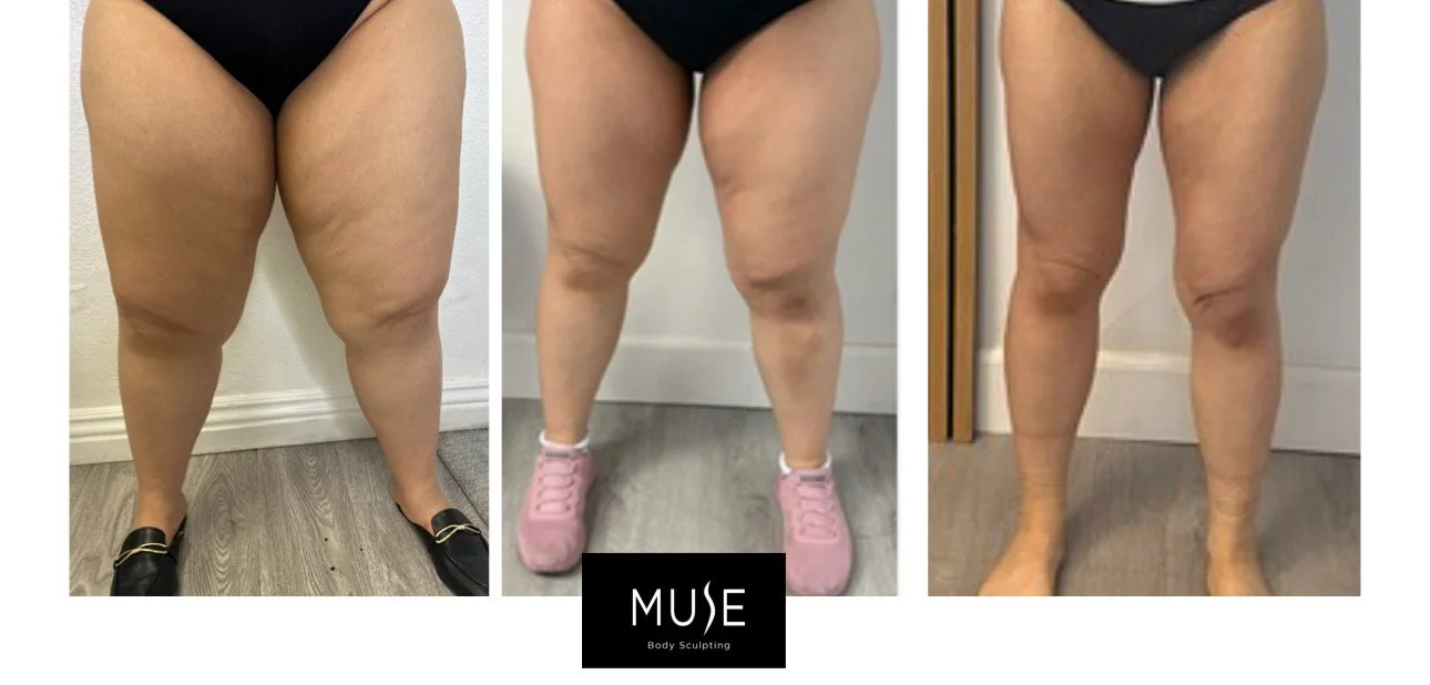 6 sessions Cryolipolysis Bundle