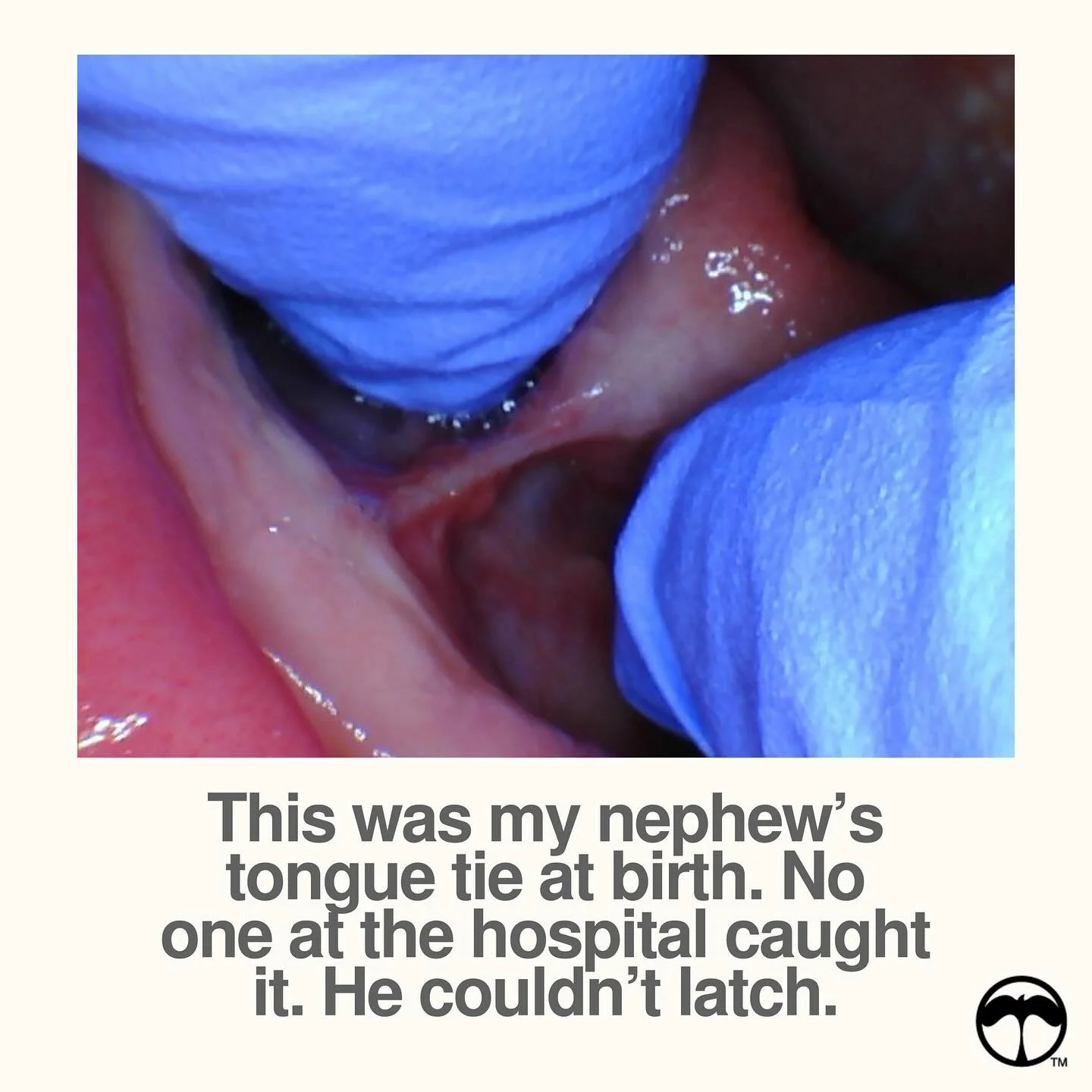 We all hope for the smoothest birth and feeding journey.
But sometimes, things don&rsquo;t go as planned.

When my nephew was born, no one caught his tongue tie in the hospital. My sister was told to keep trying then they gave her formula and a bottl