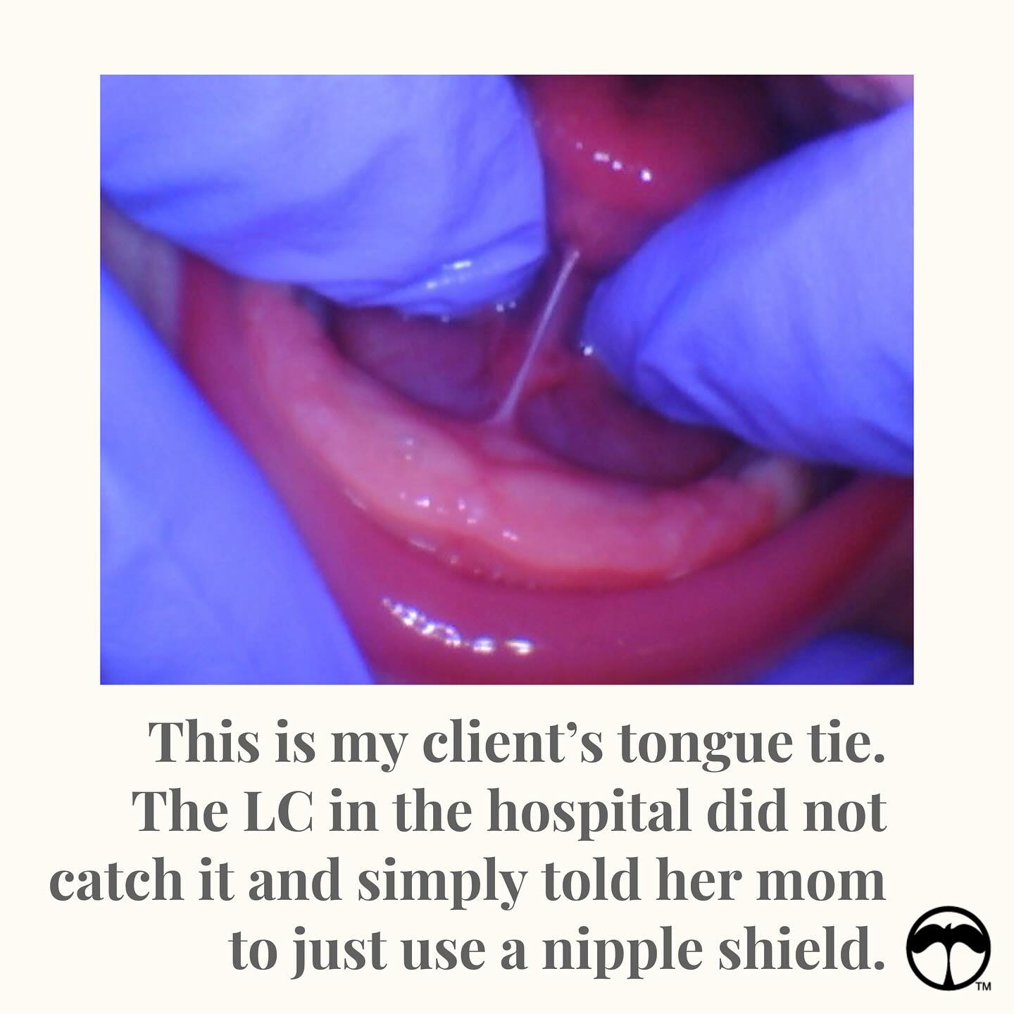 So many parents are told two extremes when their baby is diagnosed with a tongue-tie or lip-tie:

➡️ &ldquo;Do surgery right away.&rdquo;
➡️ &ldquo;It&rsquo;s fine &mdash; do nothing.&rdquo;

But neither of those answers your biggest question:
&ldquo