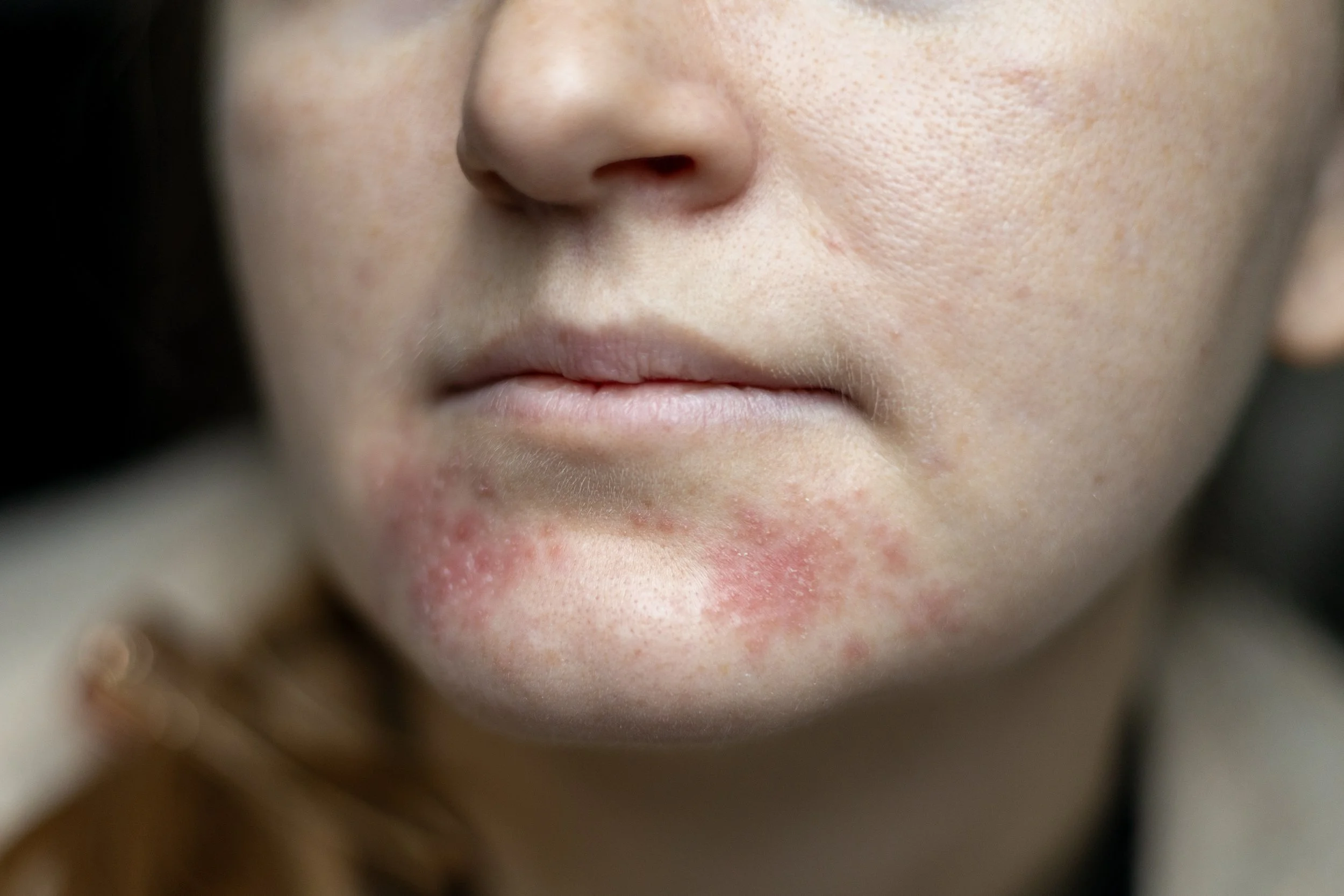 Perioral Dermatitis