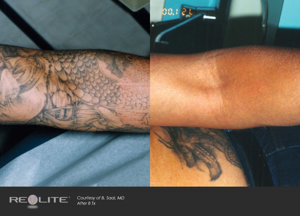 Tattoo Removal: 5 Myths & 5 Truths — 1192 Laser & Beauty Clinic