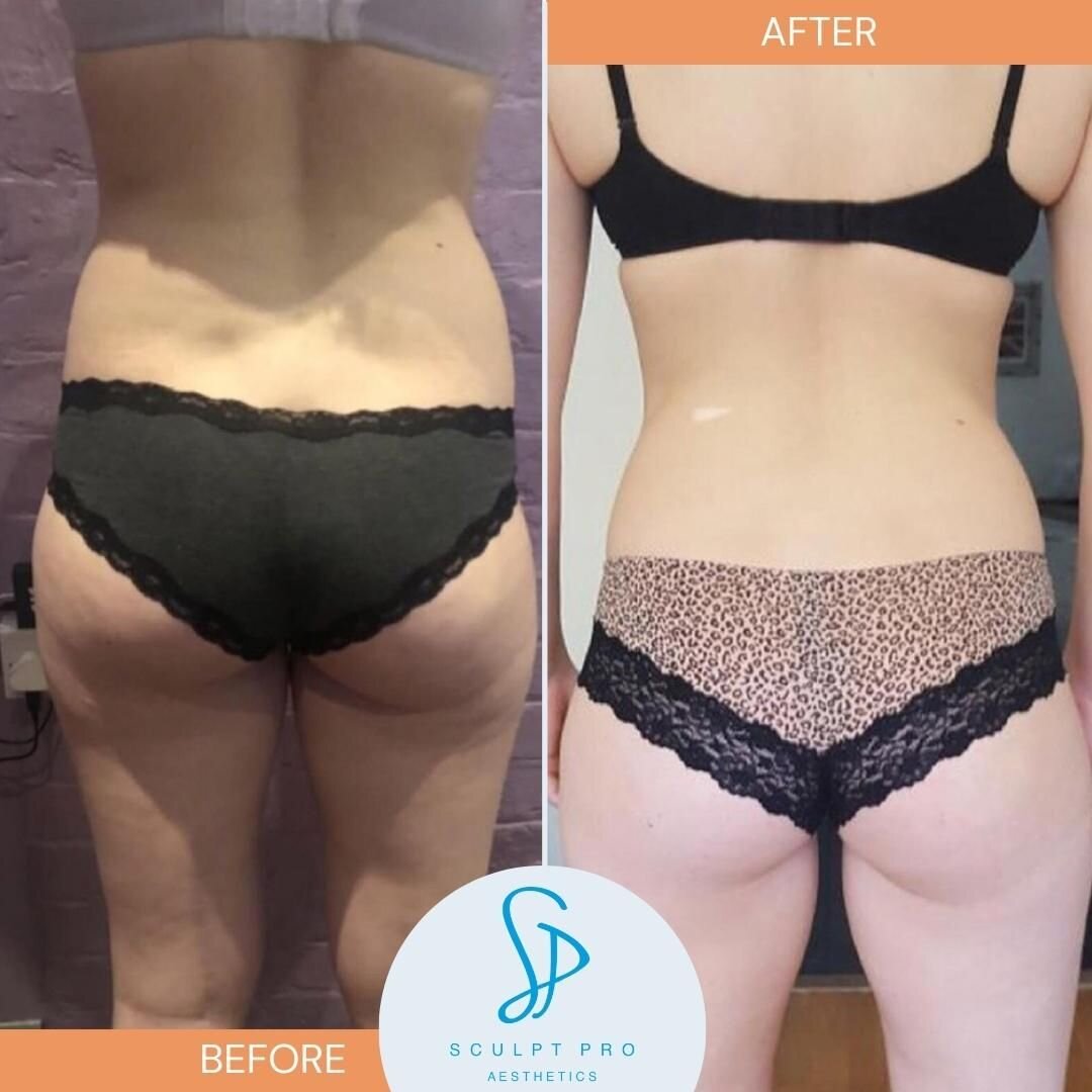 More fab results from Sculpt Pro from Ultrasound Cavitation 🧡

Book an Ultrasound Cavitation Consultation at the link in the bio.

#swansea #beauty #aesthetics #laser #lasertreatment #lasertreatmentswansea #laserhairremoval #laserhairremovalswansea 