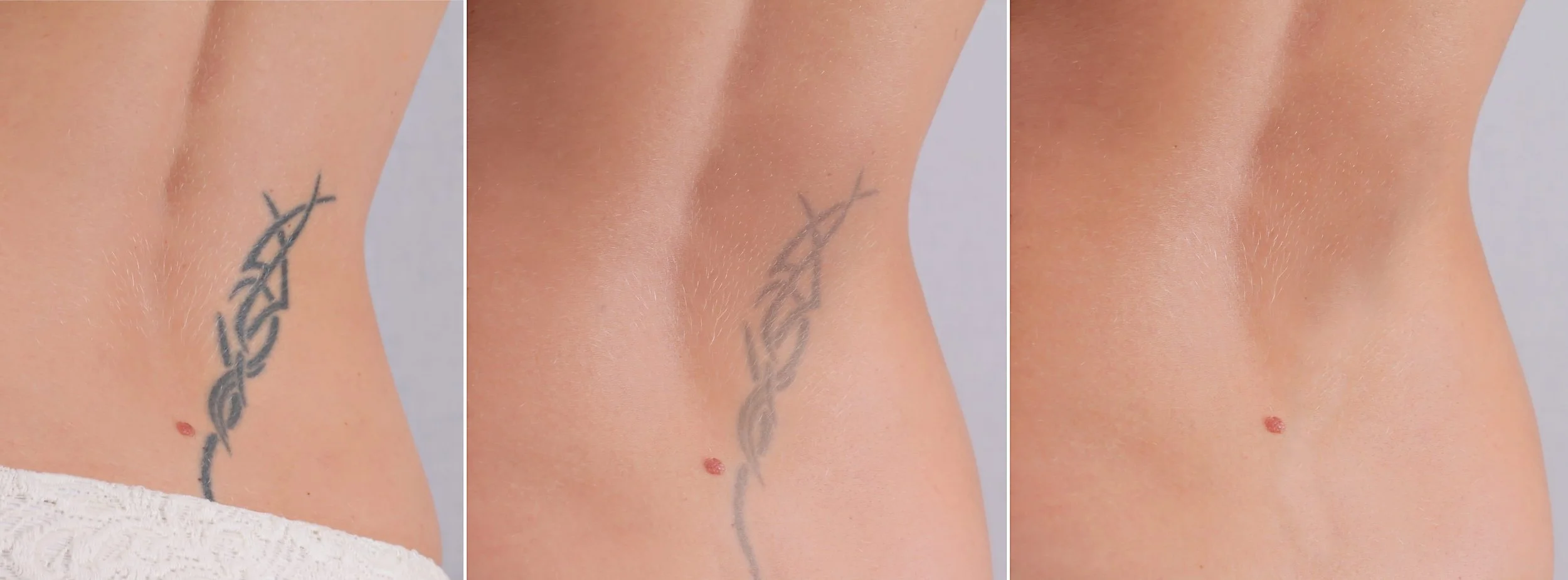 Tattoo Removal in Swansea: What to Expect Before, During &amp; After Laser Removal