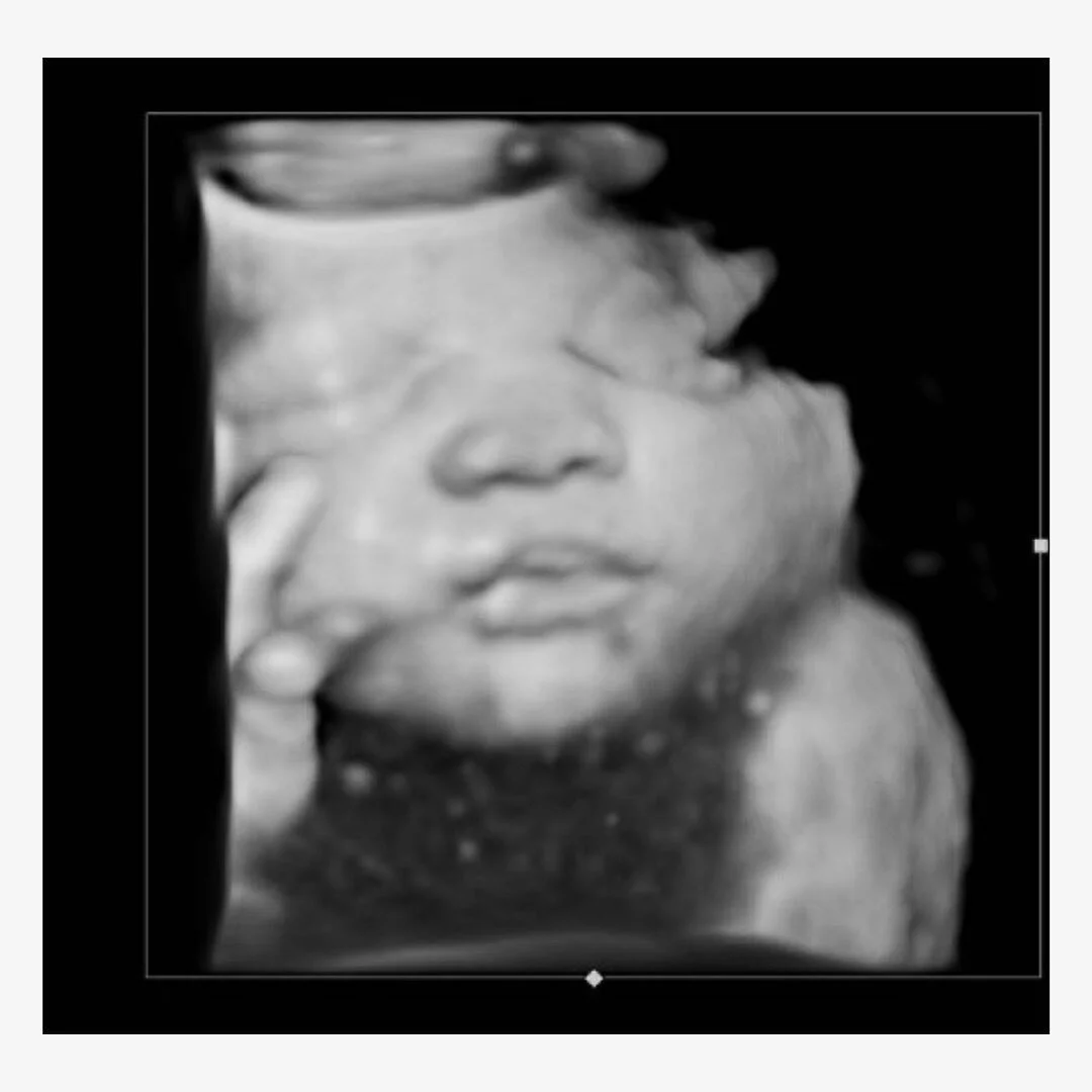 Strike a pose 🤍
.
.
#3dultrasound #4dultrasound #pregnancy #babyboutique #chubbycheeks #duedate #thirdtrimester