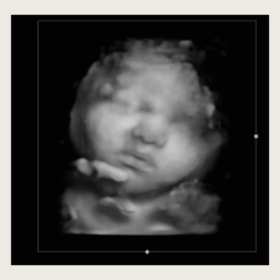 Those lips 🤍
.
.
#baby #cutenessoverload #babyboutique #3dultrasound #4dultrasound #pregnancy #34weekspregnant #33weekspregnant #32weekspregnant #duedate #westchesterny