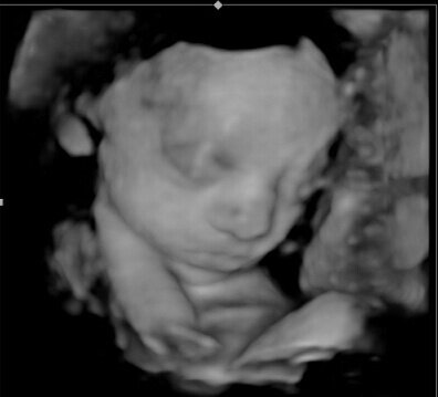 3d ultrasound near me, westchester 3d ultrasound
