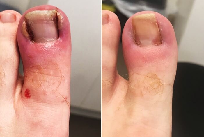 Ingrowing Toe nails — Valentine Podiatry