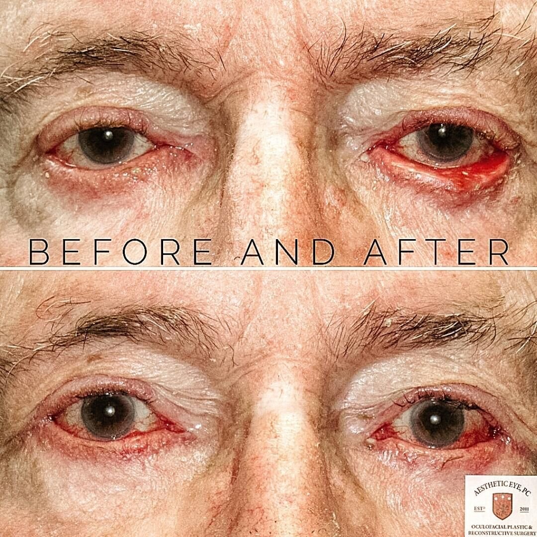 Dr M likes to joke with our pts and reminds them not to rub their eyes or else they&rsquo;ll be his job security!🤪

Smooth, functional, and free of their eye pain! See how the lower lids are turned OUT? Doc has specialized surgical skills for this a