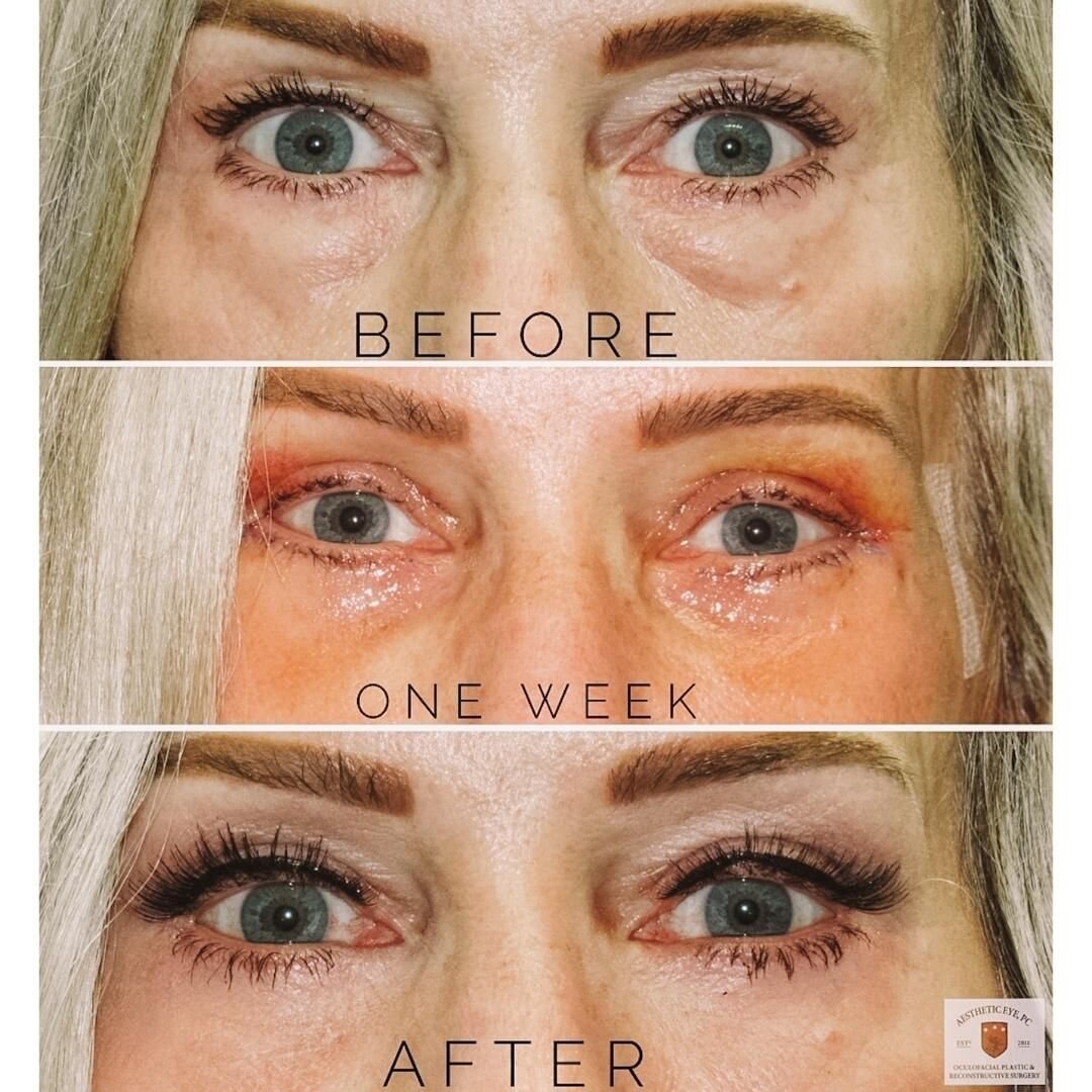 UPPER and LOWER eyelid lift (Blepharoplasty) on our wonderful patient😍 

YOUR EYES are beautiful 🤩 Trust your eyelids to a qualified surgeon to have smooth and lifted lids. 

Individual results will vary, photo for information only. See a qualified