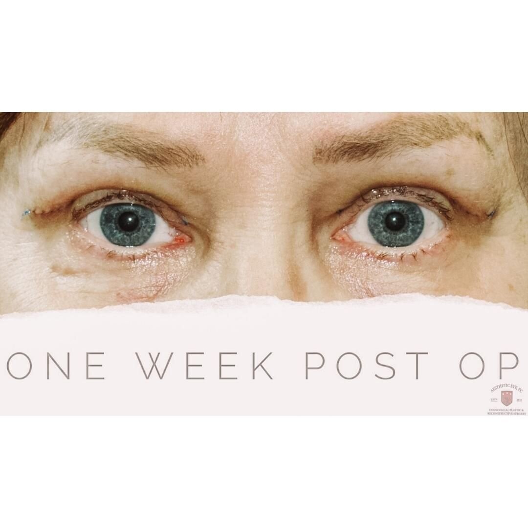 Let&rsquo;s talk about your healing process!

👉Pt pictured is one week out of her BUL blepharoplasty.☝️

👉At your one week post op appointment your polypropylene sutures are removed! Ointment is used for two weeks after surgery. 

👉Bruising, swell