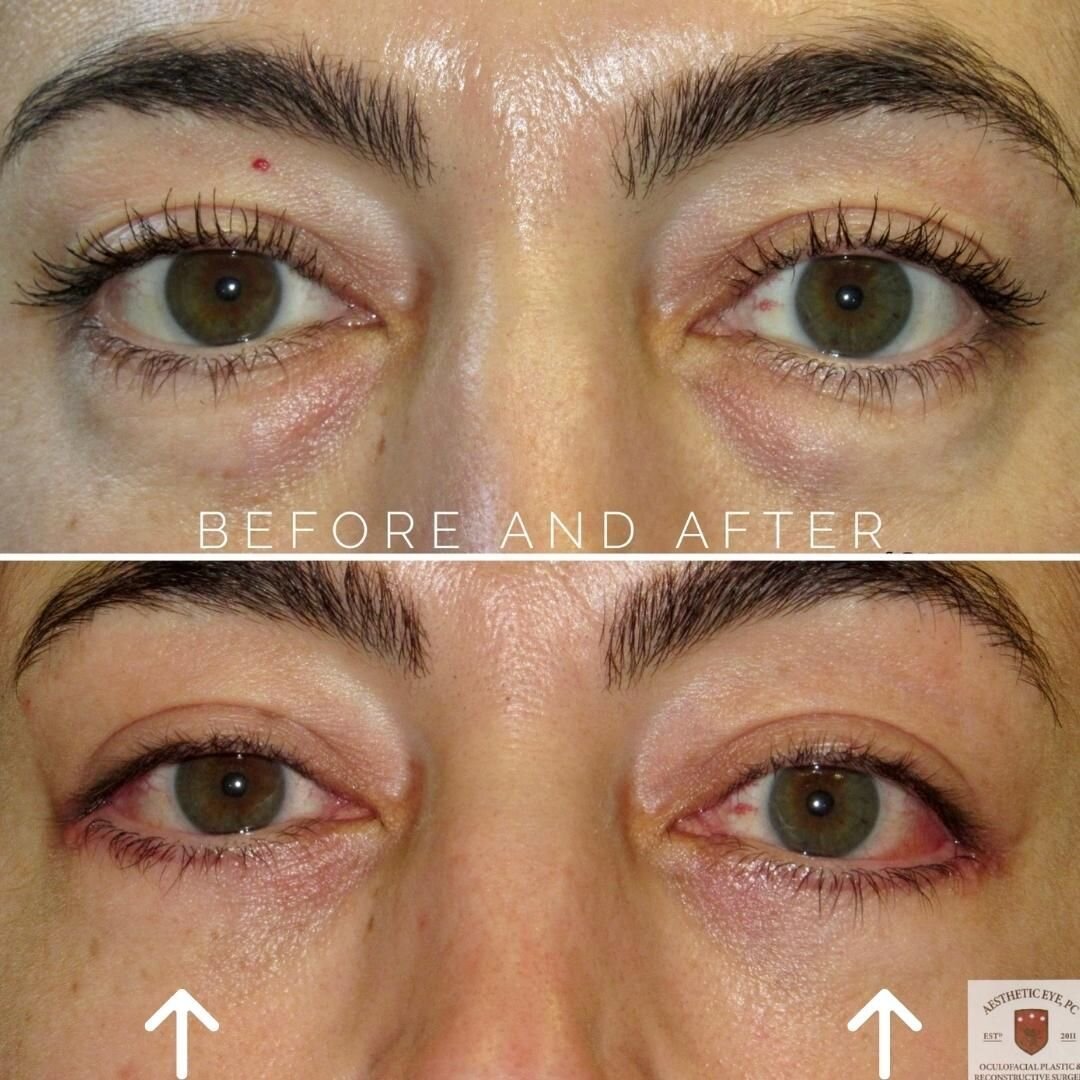 LOWER LIDS 🤍 smooth as butter 🤍

💉Bilateral Lower Lid Blepharoplasty on our fantastic patient. She already has beautiful eyes and this just enhanced her youthful and well rested look! 

&hearts;️&hearts;️We look at each others eyes for communicati