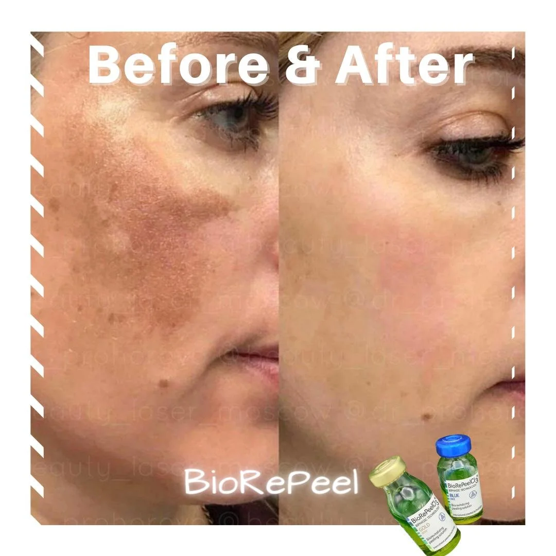 Woman's face before + after biorepeel, in the after image there is significantly less texture and discoloration.