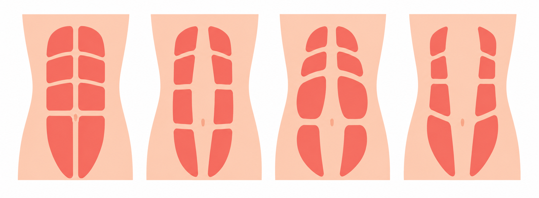 Graphic illustration of the abdominal muscles demonstrating different levels of diastasis recti, showing how the rectus abdominis separates along the midline of the body.